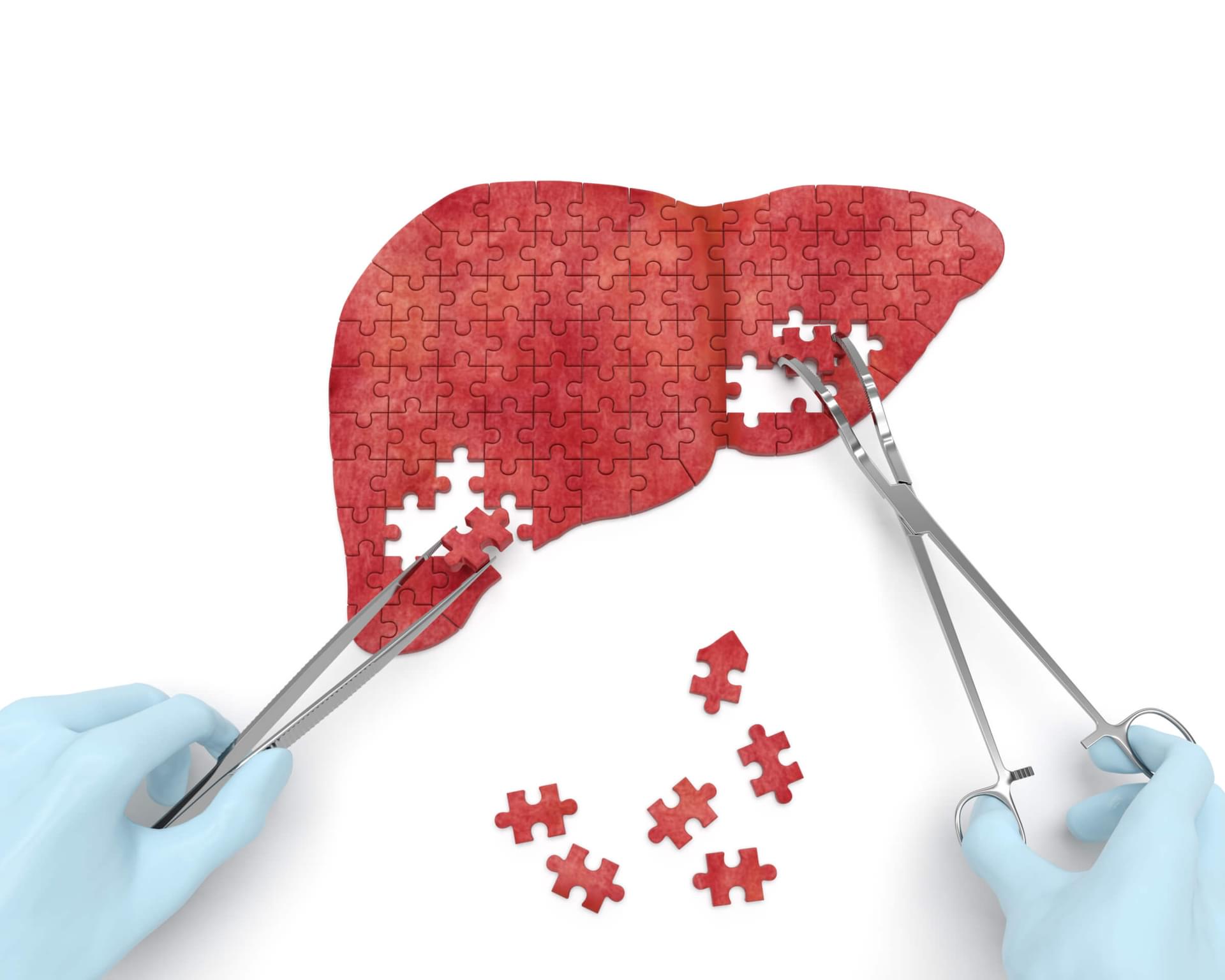 wątroba NAFLD