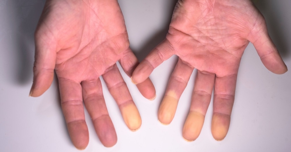 Zespół Raynauda – jak rozpoznać i różnicować w praktyce POZ?