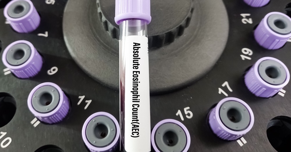Alergia, pasożyty czy nowotwór? Przyczyny eozynofilii