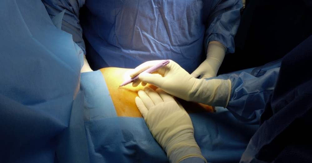 Splenektomia – jakie są wskazania do resekcji śledziony i konsekwencje tego zabiegu?