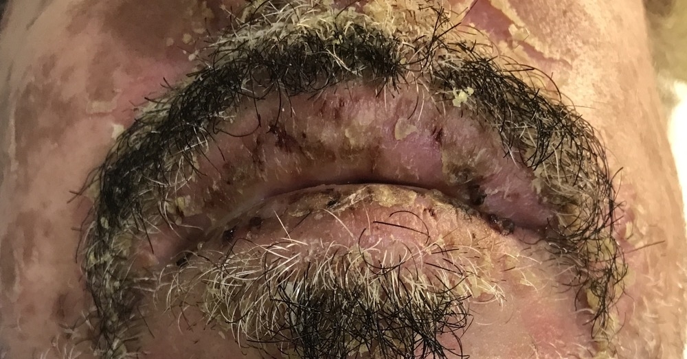 SSSS a TEN (zespół Lyella) – obie dermatozy dają spełzanie naskórka i objaw Nikolskiego, ale różnią się etiologią, rokowaniem i leczeniem. Jak je odróżnić?