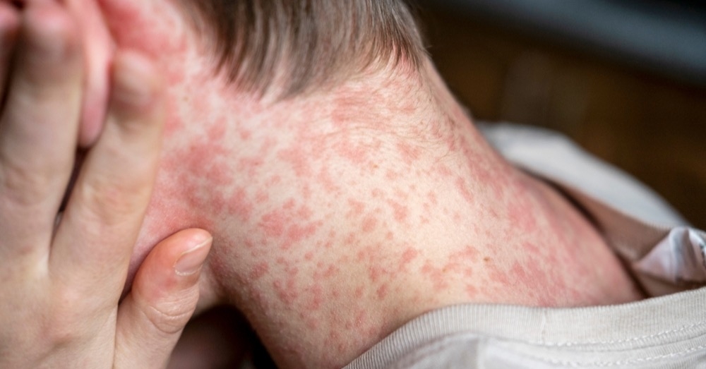 measles