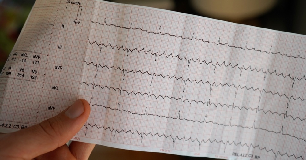 Migotanie przedsionków – czy lekarze POZ są gotowi na najnowsze wytyczne?