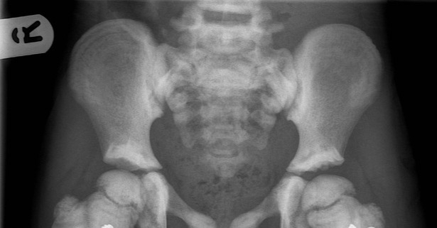 Diagnostyka osteopetrozy – od RTG do badań genetycznych