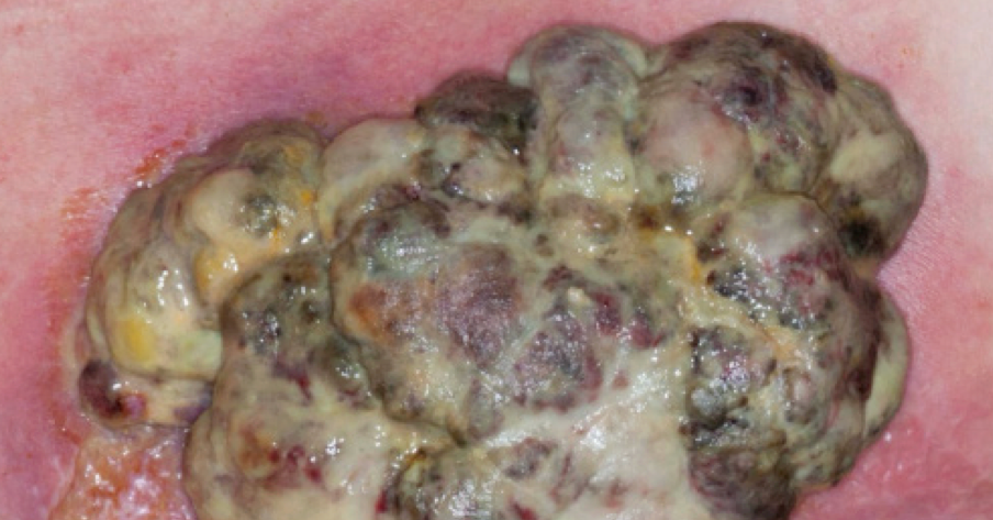 Kontrola zapachu, wysięku, bólu – realne cele w ranach nowotworowych