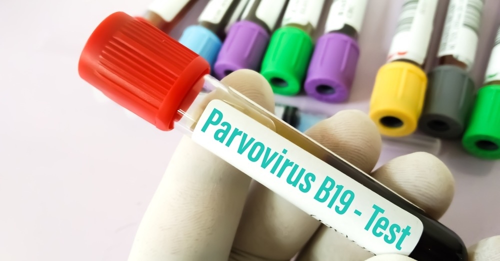 Anemia, bóle stawów, zapalenie mięśnia sercowego – różne oblicza parwowirusa B19