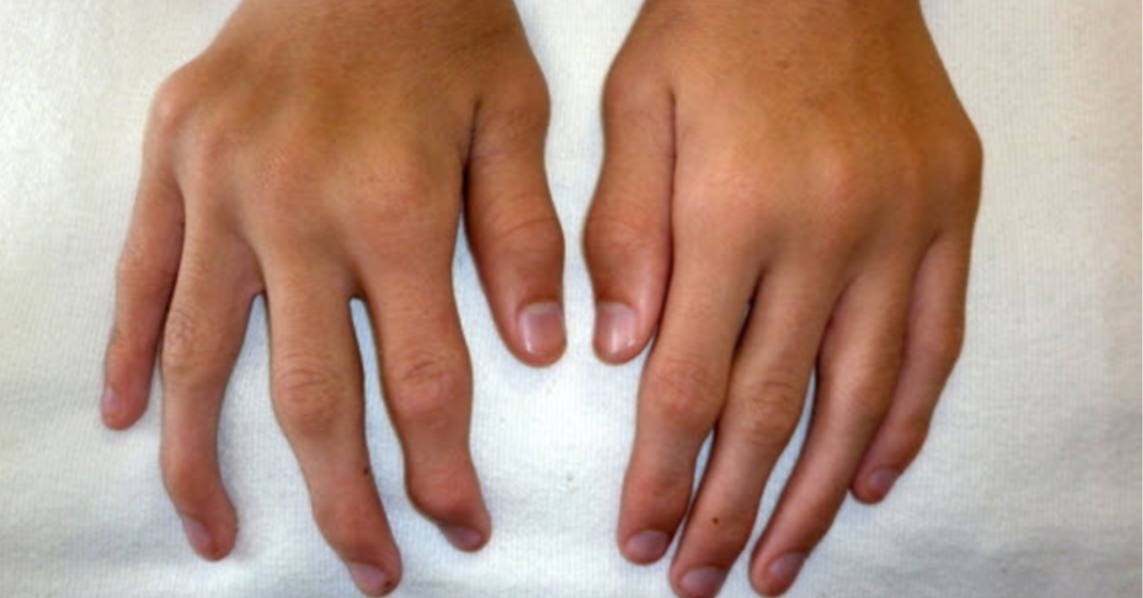 Mukopolisacharydozy to rzadkie, wielonarządowe choroby metaboliczne o zmiennym przebiegu. Wczesne rozpoznanie i terapia enzymatyczna mogą znacząco poprawić rokowanie pacjentów.