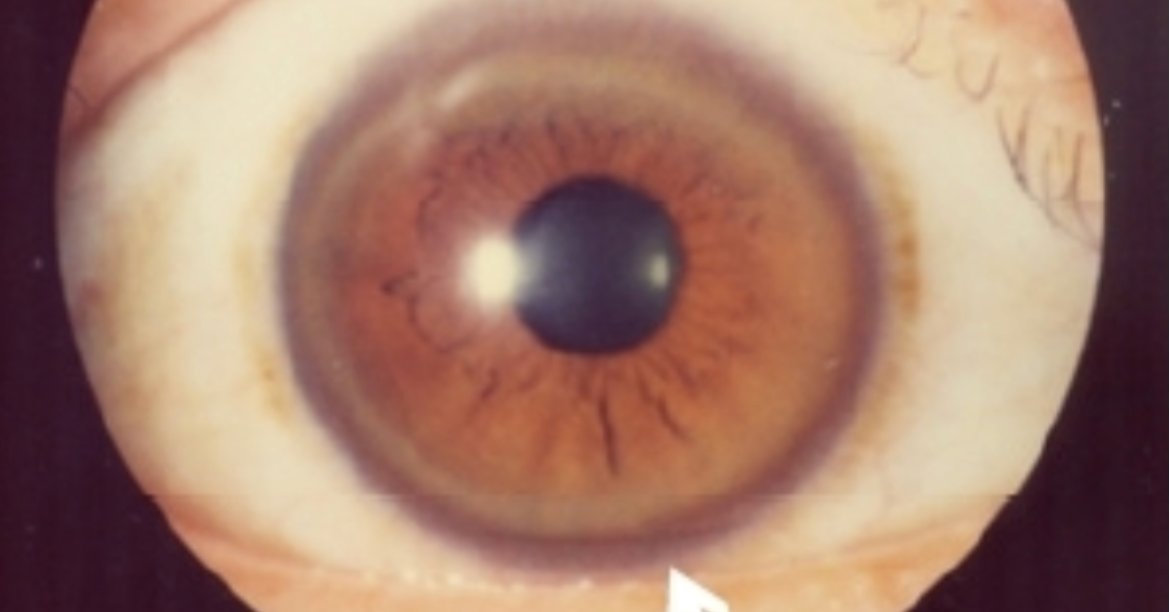 Choroba Wilsona – od podwyższonych transaminaz do zaburzeń neuropsychiatrycznych