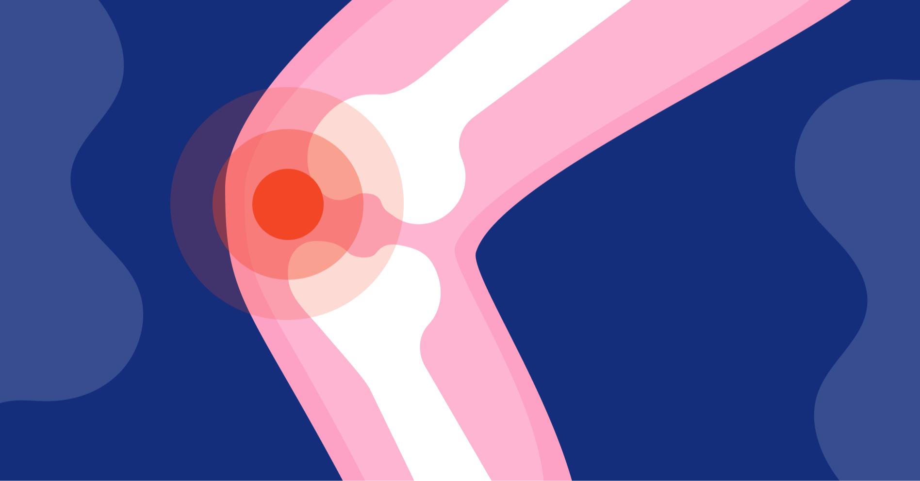 Diagnozuj i lecz: Leczenie choroby zwyrodnieniowej stawu kolanowego u pacjentki z polipragmazją