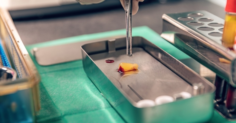 Biochirurgia w gojeniu ran przewlekłych – czy larwy mogą działać lepiej niż skalpel?