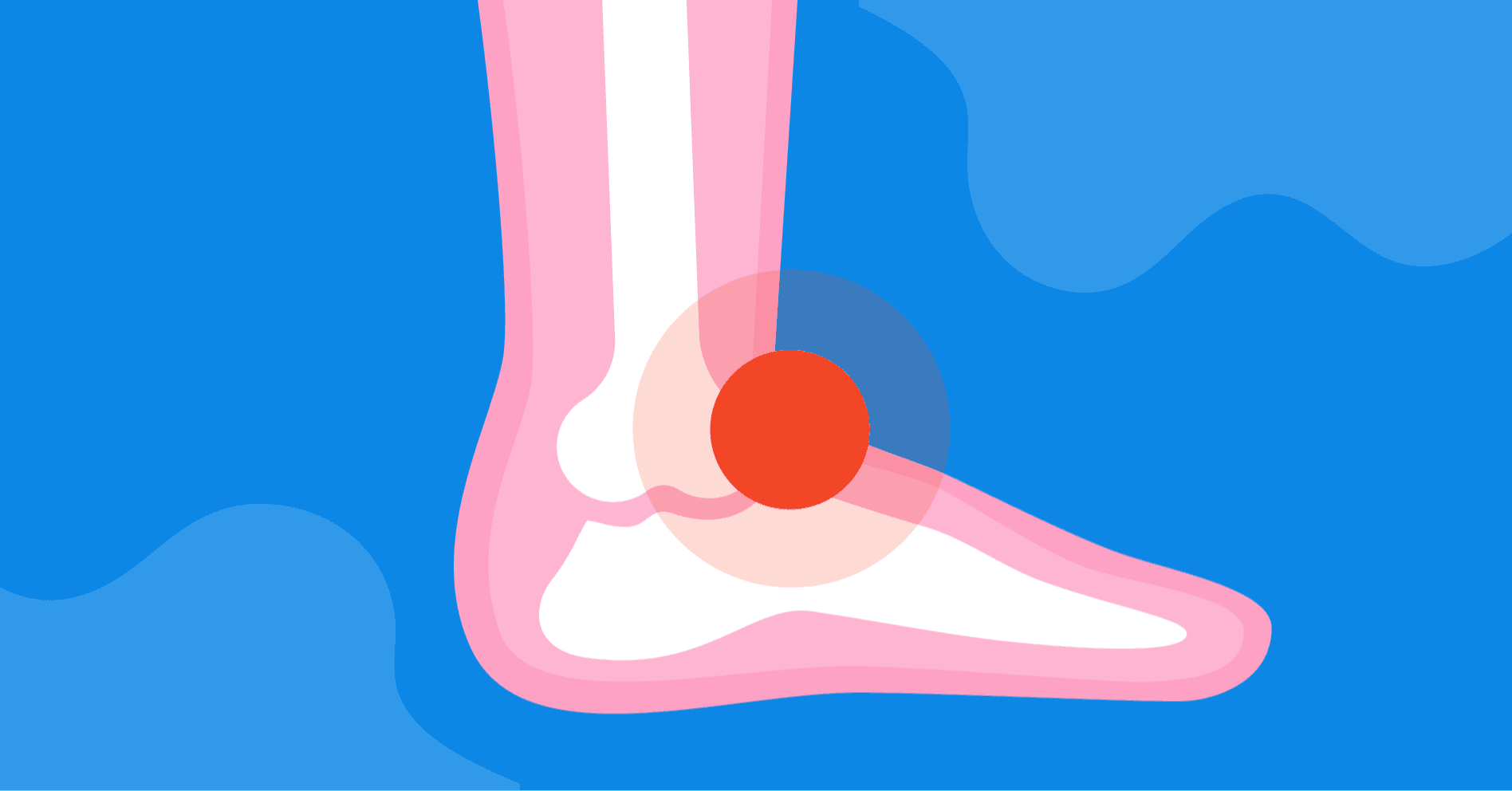 Diagnozuj i lecz: Uraz skrętny stawu skokowego