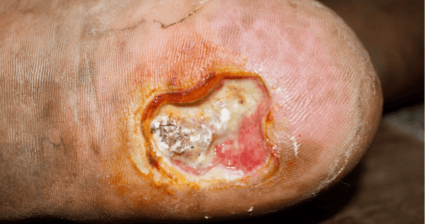 Owrzodzenia – etiologia żylna, tętnicza czy mieszana?