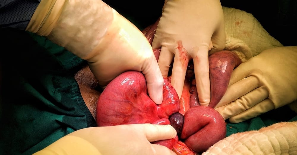 Uchyłek Meckela – konsekwencje najczęstszej wady wrodzonej przewodu pokarmowego