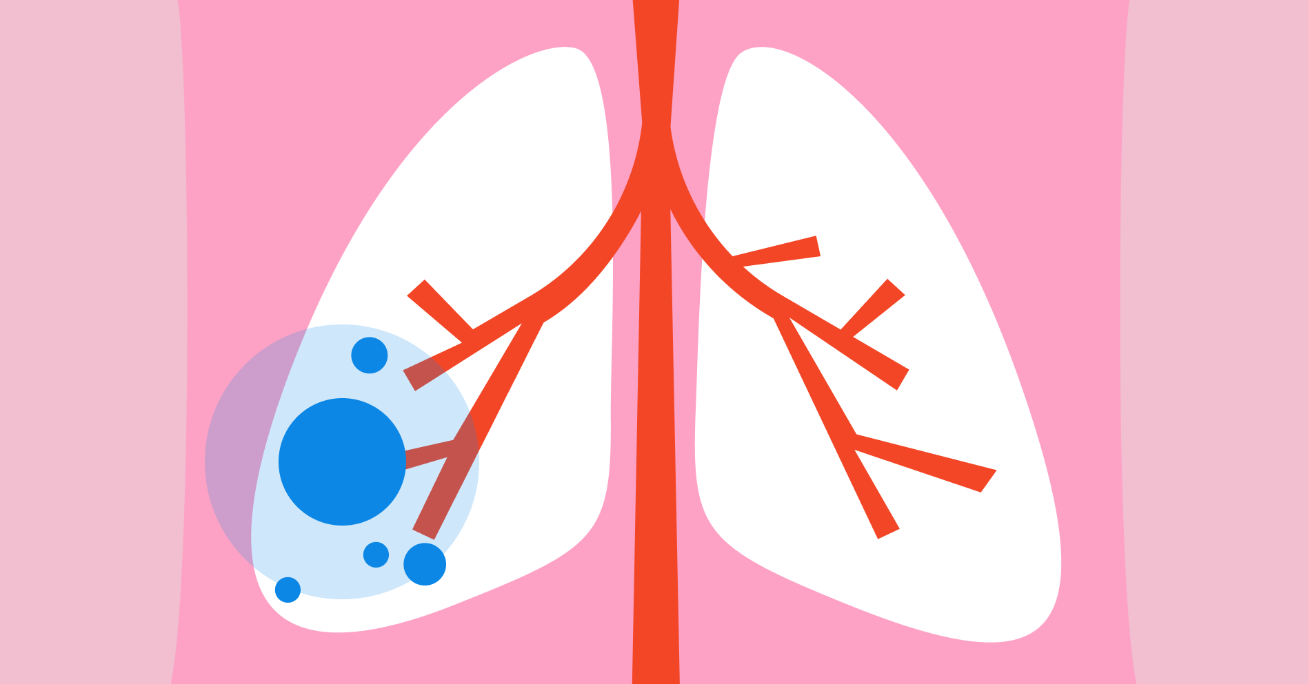Diagnozuj i lecz: pacjent ze wznową raka gruczołowego płuca