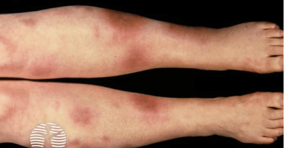 Poza przewodem pokarmowym – manifestacje pozajelitowe NZJ, o których łatwo zapomnieć