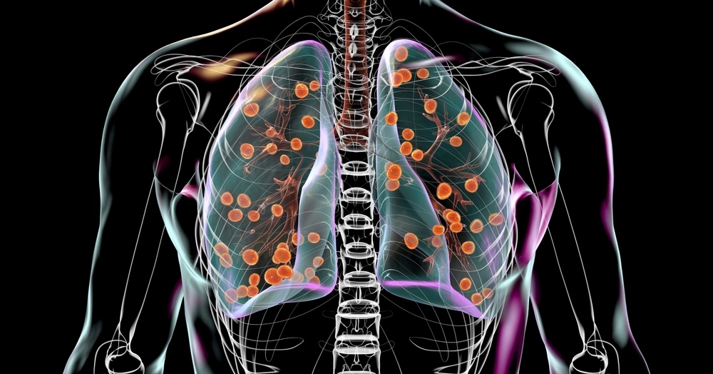 Aspergiloza, mukormykoza, kryptokokoza – grzybice płuc u pacjentów immunoniekompetentnych
