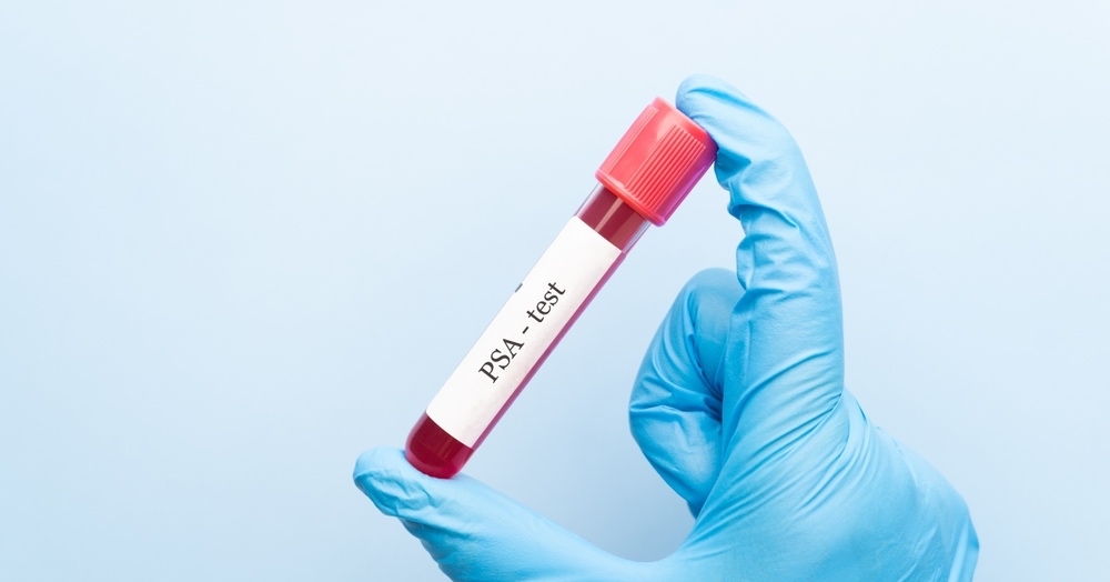 PSA – kiedy oznaczać i jak interpretować?