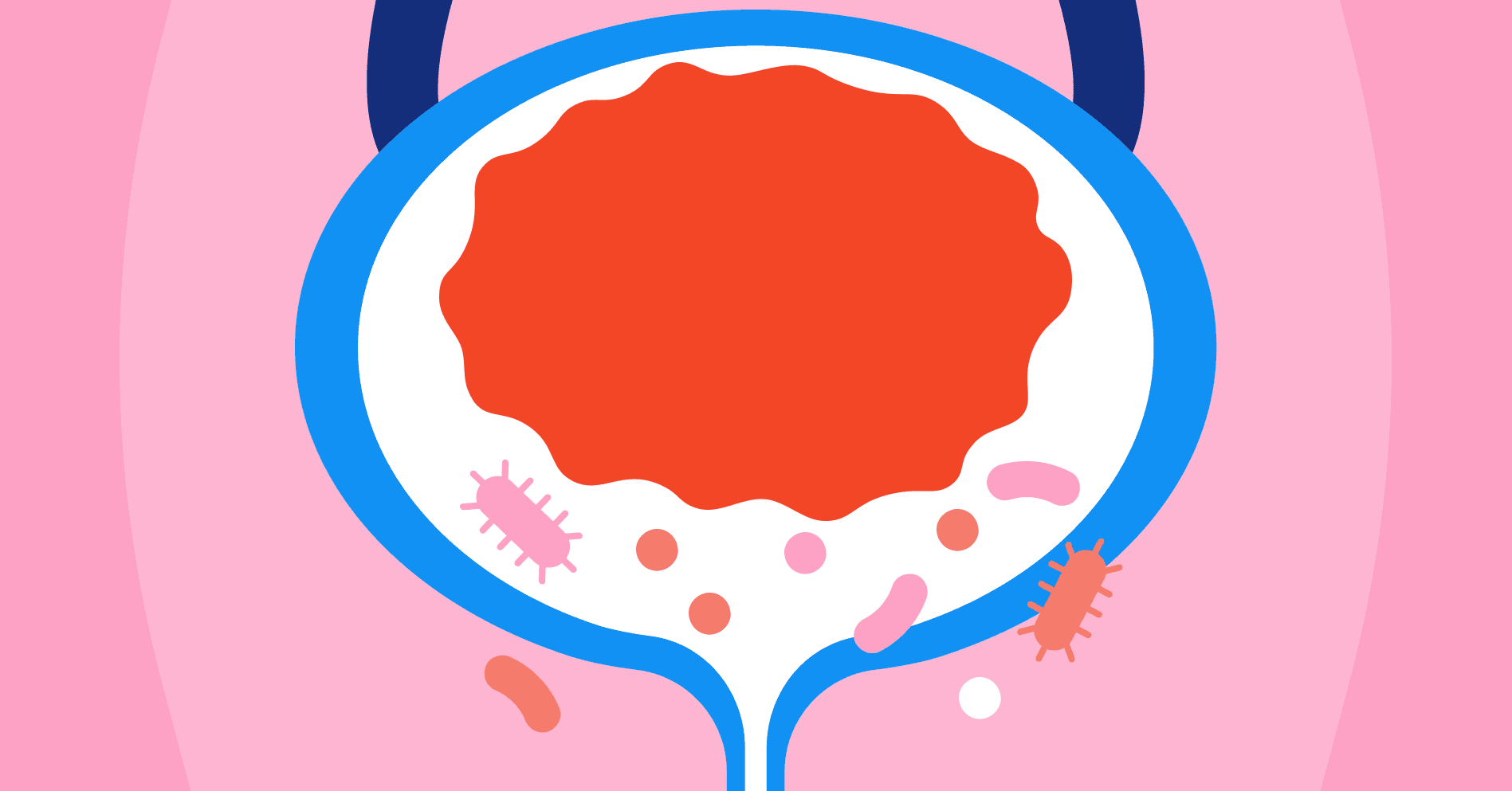 Diagnozuj i lecz: ostre bakteryjne zapalenie pęcherza u pacjentki z wielochorobowością