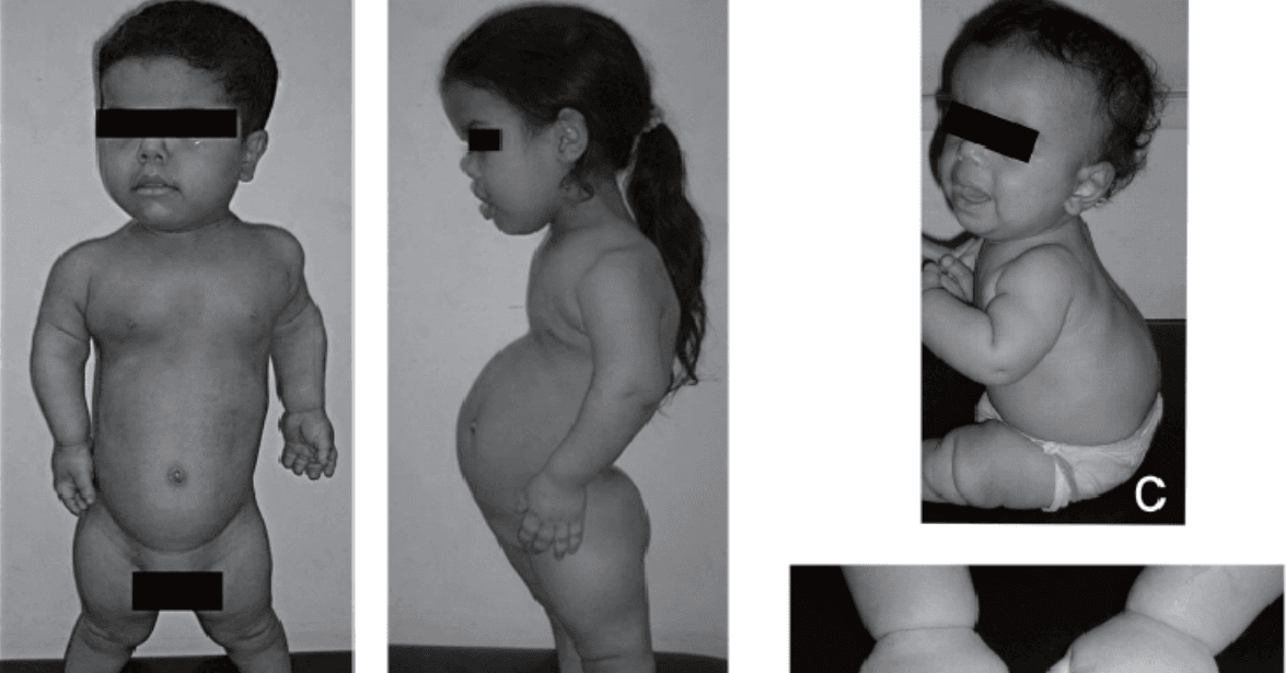 Achondroplazja – objawy, diagnostyka i opieka wielospecjalistyczna