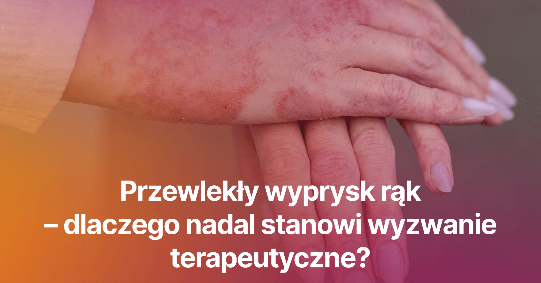 Przewlekły wyprysk rąk – dlaczego nadal stanowi wyzwanie terapeutyczne?