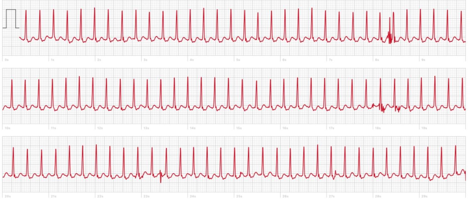 zapis EKG