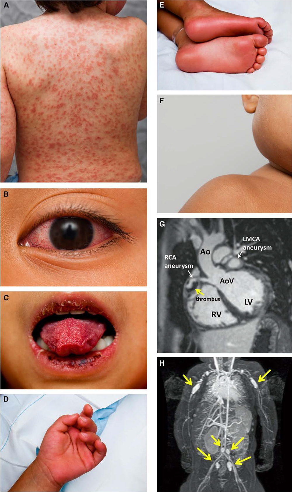 <em>źródło zdjęcia: doi.org/</em><a style="border-color: hsl(var(--border)); border-image-source: none; --tw-border-spacing-x: 0; --tw-border-spacing-y: 0; --tw-translate-x: 0; --tw-translate-y: 0; --tw-rotate: 0; --tw-skew-x: 0; --tw-skew-y: 0; --tw-scale-x: 1; --tw-scale-y: 1; --tw-pan-x: ; --tw-pan-y: ; --tw-pinch-zoom: ; --tw-scroll-snap-strictness: proximity; --tw-gradient-from-position: ; --tw-gradient-via-position: ; --tw-gradient-to-position: ; --tw-ordinal: ; --tw-slashed-zero: ; --tw-numeric-figure: ; --tw-numeric-spacing: ; --tw-numeric-fraction: ; --tw-ring-inset: ; --tw-ring-offset-width: 0px; --tw-ring-offset-color: #fff; --tw-ring-color: rgba(59,130,246,0.5); --tw-ring-offset-shadow: 0 0 #0000; --tw-ring-shadow: 0 0 #0000; --tw-shadow: 0 0 #0000; --tw-shadow-colored: 0 0 #0000; --tw-blur: ; --tw-brightness: ; --tw-contrast: ; --tw-grayscale: ; --tw-hue-rotate: ; --tw-invert: ; --tw-saturate: ; --tw-sepia: ; --tw-drop-shadow: ; --tw-backdrop-blur: ; --tw-backdrop-brightness: ; --tw-backdrop-contrast: ; --tw-backdrop-grayscale: ; --tw-backdrop-hue-rotate: ; --tw-backdrop-invert: ; --tw-backdrop-opacity: ; --tw-backdrop-saturate: ; --tw-backdrop-sepia: ; outline-color: currentcolor; outline-style: none; text-decoration-style: solid; text-decoration-color: currentcolor;" href="https://www.ahajournals.org/doi/10.1161/cir.0000000000000484"><span style="border-color: hsl(var(--border)); border-image-source: none; --tw-border-spacing-x: 0; --tw-border-spacing-y: 0; --tw-translate-x: 0; --tw-translate-y: 0; --tw-rotate: 0; --tw-skew-x: 0; --tw-skew-y: 0; --tw-scale-x: 1; --tw-scale-y: 1; --tw-pan-x: ; --tw-pan-y: ; --tw-pinch-zoom: ; --tw-scroll-snap-strictness: proximity; --tw-gradient-from-position: ; --tw-gradient-via-position: ; --tw-gradient-to-position: ; --tw-ordinal: ; --tw-slashed-zero: ; --tw-numeric-figure: ; --tw-numeric-spacing: ; --tw-numeric-fraction: ; --tw-ring-inset: ; --tw-ring-offset-width: 0px; --tw-ring-offset-color: #fff; --tw-ring-color: rgba(59,130,246,0.5); --tw-ring-offset-shadow: 0 0 #0000; --tw-ring-shadow: 0 0 #0000; --tw-shadow: 0 0 #0000; --tw-shadow-colored: 0 0 #0000; --tw-blur: ; --tw-brightness: ; --tw-contrast: ; --tw-grayscale: ; --tw-hue-rotate: ; --tw-invert: ; --tw-saturate: ; --tw-sepia: ; --tw-drop-shadow: ; --tw-backdrop-blur: ; --tw-backdrop-brightness: ; --tw-backdrop-contrast: ; --tw-backdrop-grayscale: ; --tw-backdrop-hue-rotate: ; --tw-backdrop-invert: ; --tw-backdrop-opacity: ; --tw-backdrop-saturate: ; --tw-backdrop-sepia: ; outline-color: currentcolor; outline-style: none; font-size: 11pt; font-family: Arial, sans-serif; color: rgb(17, 85, 204); font-style: italic; font-variant-ligatures: normal; font-variant-alternates: normal; font-variant-numeric: normal; font-variant-east-asian: normal; font-variant-position: normal; text-decoration-skip-ink: none; vertical-align: baseline; white-space: pre-wrap;"></span><em style="border-color: hsl(var(--border)); border-image-source: none; --tw-border-spacing-x: 0; --tw-border-spacing-y: 0; --tw-translate-x: 0; --tw-translate-y: 0; --tw-rotate: 0; --tw-skew-x: 0; --tw-skew-y: 0; --tw-scale-x: 1; --tw-scale-y: 1; --tw-pan-x: ; --tw-pan-y: ; --tw-pinch-zoom: ; --tw-scroll-snap-strictness: proximity; --tw-gradient-from-position: ; --tw-gradient-via-position: ; --tw-gradient-to-position: ; --tw-ordinal: ; --tw-slashed-zero: ; --tw-numeric-figure: ; --tw-numeric-spacing: ; --tw-numeric-fraction: ; --tw-ring-inset: ; --tw-ring-offset-width: 0px; --tw-ring-offset-color: #fff; --tw-ring-color: rgba(59,130,246,0.5); --tw-ring-offset-shadow: 0 0 #0000; --tw-ring-shadow: 0 0 #0000; --tw-shadow: 0 0 #0000; --tw-shadow-colored: 0 0 #0000; --tw-blur: ; --tw-brightness: ; --tw-contrast: ; --tw-grayscale: ; --tw-hue-rotate: ; --tw-invert: ; --tw-saturate: ; --tw-sepia: ; --tw-drop-shadow: ; --tw-backdrop-blur: ; --tw-backdrop-brightness: ; --tw-backdrop-contrast: ; --tw-backdrop-grayscale: ; --tw-backdrop-hue-rotate: ; --tw-backdrop-invert: ; --tw-backdrop-opacity: ; --tw-backdrop-saturate: ; --tw-backdrop-sepia: ; outline-color: currentcolor; outline-style: none;"></em><em style="border-color: hsl(var(--border)); border-image-source: none; --tw-border-spacing-x: 0; --tw-border-spacing-y: 0; --tw-translate-x: 0; --tw-translate-y: 0; --tw-rotate: 0; --tw-skew-x: 0; --tw-skew-y: 0; --tw-scale-x: 1; --tw-scale-y: 1; --tw-pan-x: ; --tw-pan-y: ; --tw-pinch-zoom: ; --tw-scroll-snap-strictness: proximity; --tw-gradient-from-position: ; --tw-gradient-via-position: ; --tw-gradient-to-position: ; --tw-ordinal: ; --tw-slashed-zero: ; --tw-numeric-figure: ; --tw-numeric-spacing: ; --tw-numeric-fraction: ; --tw-ring-inset: ; --tw-ring-offset-width: 0px; --tw-ring-offset-color: #fff; --tw-ring-color: rgba(59,130,246,0.5); --tw-ring-offset-shadow: 0 0 #0000; --tw-ring-shadow: 0 0 #0000; --tw-shadow: 0 0 #0000; --tw-shadow-colored: 0 0 #0000; --tw-blur: ; --tw-brightness: ; --tw-contrast: ; --tw-grayscale: ; --tw-hue-rotate: ; --tw-invert: ; --tw-saturate: ; --tw-sepia: ; --tw-drop-shadow: ; --tw-backdrop-blur: ; --tw-backdrop-brightness: ; --tw-backdrop-contrast: ; --tw-backdrop-grayscale: ; --tw-backdrop-hue-rotate: ; --tw-backdrop-invert: ; --tw-backdrop-opacity: ; --tw-backdrop-saturate: ; --tw-backdrop-sepia: ; outline-color: currentcolor; outline-style: none;"></em><em style="border-color: hsl(var(--border)); border-image-source: none; --tw-border-spacing-x: 0; --tw-border-spacing-y: 0; --tw-translate-x: 0; --tw-translate-y: 0; --tw-rotate: 0; --tw-skew-x: 0; --tw-skew-y: 0; --tw-scale-x: 1; --tw-scale-y: 1; --tw-pan-x: ; --tw-pan-y: ; --tw-pinch-zoom: ; --tw-scroll-snap-strictness: proximity; --tw-gradient-from-position: ; --tw-gradient-via-position: ; --tw-gradient-to-position: ; --tw-ordinal: ; --tw-slashed-zero: ; --tw-numeric-figure: ; --tw-numeric-spacing: ; --tw-numeric-fraction: ; --tw-ring-inset: ; --tw-ring-offset-width: 0px; --tw-ring-offset-color: #fff; --tw-ring-color: rgba(59,130,246,0.5); --tw-ring-offset-shadow: 0 0 #0000; --tw-ring-shadow: 0 0 #0000; --tw-shadow: 0 0 #0000; --tw-shadow-colored: 0 0 #0000; --tw-blur: ; --tw-brightness: ; --tw-contrast: ; --tw-grayscale: ; --tw-hue-rotate: ; --tw-invert: ; --tw-saturate: ; --tw-sepia: ; --tw-drop-shadow: ; --tw-backdrop-blur: ; --tw-backdrop-brightness: ; --tw-backdrop-contrast: ; --tw-backdrop-grayscale: ; --tw-backdrop-hue-rotate: ; --tw-backdrop-invert: ; --tw-backdrop-opacity: ; --tw-backdrop-saturate: ; --tw-backdrop-sepia: ; outline-color: currentcolor; outline-style: none;"></em><em></em><em></em><em></em><em>10.1161/cir.0000000000000484</em></a>