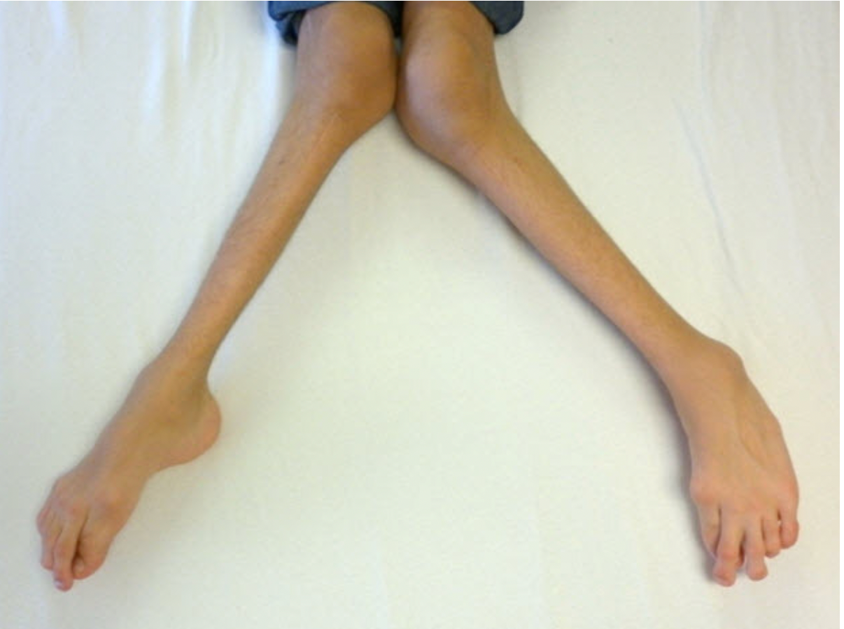 <em>Koślawość kolan u 15-letniego pacjenta z MPS IVA. Źródło zdjęcia: </em><a style="border-color: hsl(var(--border)); border-image-source: none; --tw-border-spacing-x: 0; --tw-border-spacing-y: 0; --tw-translate-x: 0; --tw-translate-y: 0; --tw-rotate: 0; --tw-skew-x: 0; --tw-skew-y: 0; --tw-scale-x: 1; --tw-scale-y: 1; --tw-pan-x: ; --tw-pan-y: ; --tw-pinch-zoom: ; --tw-scroll-snap-strictness: proximity; --tw-gradient-from-position: ; --tw-gradient-via-position: ; --tw-gradient-to-position: ; --tw-ordinal: ; --tw-slashed-zero: ; --tw-numeric-figure: ; --tw-numeric-spacing: ; --tw-numeric-fraction: ; --tw-ring-inset: ; --tw-ring-offset-width: 0px; --tw-ring-offset-color: #fff; --tw-ring-color: rgba(59,130,246,0.5); --tw-ring-offset-shadow: 0 0 #0000; --tw-ring-shadow: 0 0 #0000; --tw-shadow: 0 0 #0000; --tw-shadow-colored: 0 0 #0000; --tw-blur: ; --tw-brightness: ; --tw-contrast: ; --tw-grayscale: ; --tw-hue-rotate: ; --tw-invert: ; --tw-saturate: ; --tw-sepia: ; --tw-drop-shadow: ; --tw-backdrop-blur: ; --tw-backdrop-brightness: ; --tw-backdrop-contrast: ; --tw-backdrop-grayscale: ; --tw-backdrop-hue-rotate: ; --tw-backdrop-invert: ; --tw-backdrop-opacity: ; --tw-backdrop-saturate: ; --tw-backdrop-sepia: ; outline-color: currentcolor; outline-style: none; text-decoration-style: solid; text-decoration-color: currentcolor;" href="https://www.ncbi.nlm.nih.gov/books/NBK148668/"><span style="border-color: hsl(var(--border)); border-image-source: none; --tw-border-spacing-x: 0; --tw-border-spacing-y: 0; --tw-translate-x: 0; --tw-translate-y: 0; --tw-rotate: 0; --tw-skew-x: 0; --tw-skew-y: 0; --tw-scale-x: 1; --tw-scale-y: 1; --tw-pan-x: ; --tw-pan-y: ; --tw-pinch-zoom: ; --tw-scroll-snap-strictness: proximity; --tw-gradient-from-position: ; --tw-gradient-via-position: ; --tw-gradient-to-position: ; --tw-ordinal: ; --tw-slashed-zero: ; --tw-numeric-figure: ; --tw-numeric-spacing: ; --tw-numeric-fraction: ; --tw-ring-inset: ; --tw-ring-offset-width: 0px; --tw-ring-offset-color: #fff; --tw-ring-color: rgba(59,130,246,0.5); --tw-ring-offset-shadow: 0 0 #0000; --tw-ring-shadow: 0 0 #0000; --tw-shadow: 0 0 #0000; --tw-shadow-colored: 0 0 #0000; --tw-blur: ; --tw-brightness: ; --tw-contrast: ; --tw-grayscale: ; --tw-hue-rotate: ; --tw-invert: ; --tw-saturate: ; --tw-sepia: ; --tw-drop-shadow: ; --tw-backdrop-blur: ; --tw-backdrop-brightness: ; --tw-backdrop-contrast: ; --tw-backdrop-grayscale: ; --tw-backdrop-hue-rotate: ; --tw-backdrop-invert: ; --tw-backdrop-opacity: ; --tw-backdrop-saturate: ; --tw-backdrop-sepia: ; outline-color: currentcolor; outline-style: none; font-size: 11pt; font-family: Arial, sans-serif; color: rgb(17, 85, 204); font-style: italic; font-variant-ligatures: normal; font-variant-alternates: normal; font-variant-numeric: normal; font-variant-east-asian: normal; font-variant-position: normal; text-decoration-skip-ink: none; vertical-align: baseline; white-space: pre-wrap;"></span><em style="border-color: hsl(var(--border)); border-image-source: none; --tw-border-spacing-x: 0; --tw-border-spacing-y: 0; --tw-translate-x: 0; --tw-translate-y: 0; --tw-rotate: 0; --tw-skew-x: 0; --tw-skew-y: 0; --tw-scale-x: 1; --tw-scale-y: 1; --tw-pan-x: ; --tw-pan-y: ; --tw-pinch-zoom: ; --tw-scroll-snap-strictness: proximity; --tw-gradient-from-position: ; --tw-gradient-via-position: ; --tw-gradient-to-position: ; --tw-ordinal: ; --tw-slashed-zero: ; --tw-numeric-figure: ; --tw-numeric-spacing: ; --tw-numeric-fraction: ; --tw-ring-inset: ; --tw-ring-offset-width: 0px; --tw-ring-offset-color: #fff; --tw-ring-color: rgba(59,130,246,0.5); --tw-ring-offset-shadow: 0 0 #0000; --tw-ring-shadow: 0 0 #0000; --tw-shadow: 0 0 #0000; --tw-shadow-colored: 0 0 #0000; --tw-blur: ; --tw-brightness: ; --tw-contrast: ; --tw-grayscale: ; --tw-hue-rotate: ; --tw-invert: ; --tw-saturate: ; --tw-sepia: ; --tw-drop-shadow: ; --tw-backdrop-blur: ; --tw-backdrop-brightness: ; --tw-backdrop-contrast: ; --tw-backdrop-grayscale: ; --tw-backdrop-hue-rotate: ; --tw-backdrop-invert: ; --tw-backdrop-opacity: ; --tw-backdrop-saturate: ; --tw-backdrop-sepia: ; outline-color: currentcolor; outline-style: none;"></em><em></em><em>https://www.ncbi.nlm.nih.gov/books/NBK148668/</em></a>