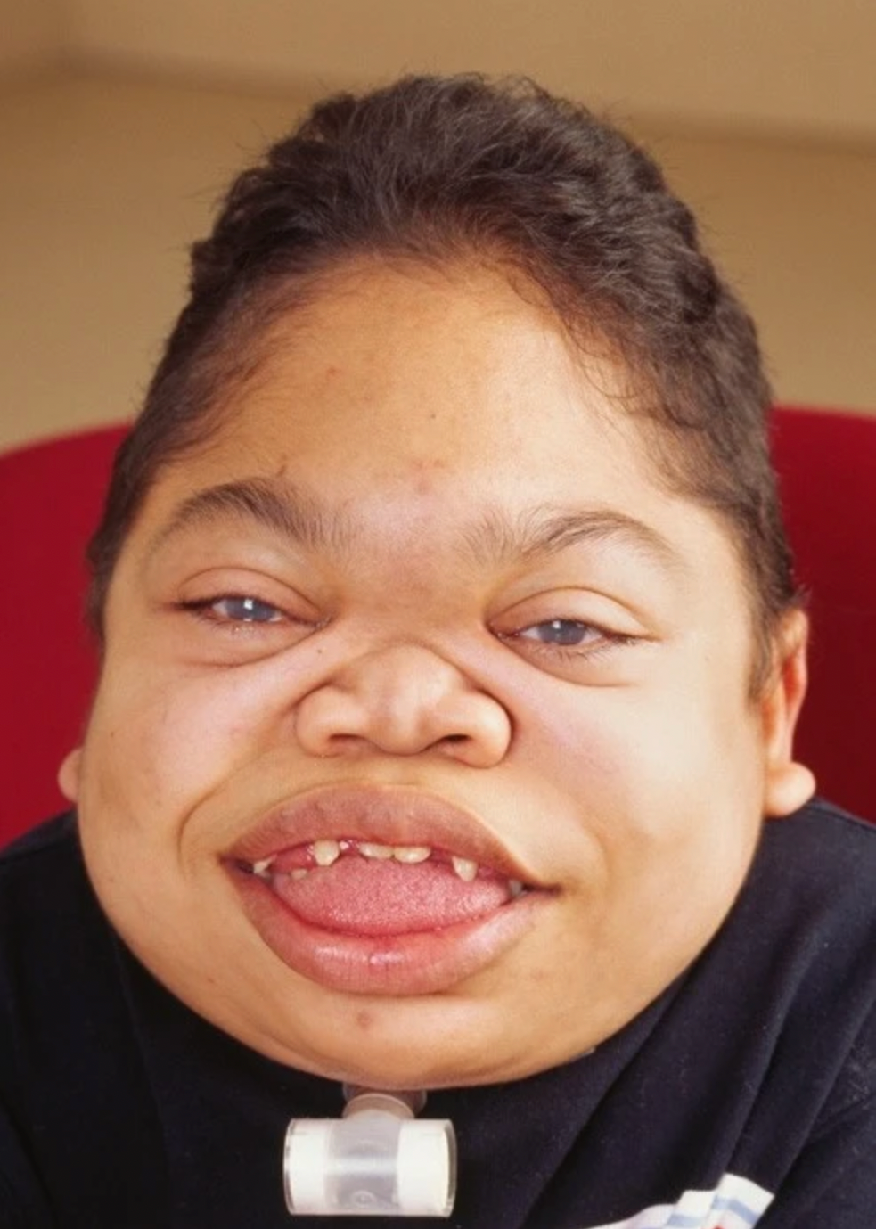 <em>MPS VI u 16-letniego pacjenta: szorstkie rysy twarzy – wydatne guzy czołowe, powiększony język, wydatne linie warg, nieprawidłowe uzębienie i przerost dziąseł. Źródło zdjęcia: </em><a style="text-decoration: none;" href="https://doi.org/10.1186/1750-1172-5-5"><span style="font-size: 11pt; font-family: Arial, sans-serif; color: rgb(17, 85, 204); font-style: italic; font-variant-ligatures: normal; font-variant-alternates: normal; font-variant-numeric: normal; font-variant-east-asian: normal; font-variant-position: normal; text-decoration: underline; text-decoration-skip-ink: none; vertical-align: baseline; white-space: pre-wrap;"></span><em>doi.org/10.1186/1750-1172-5-5</em></a>