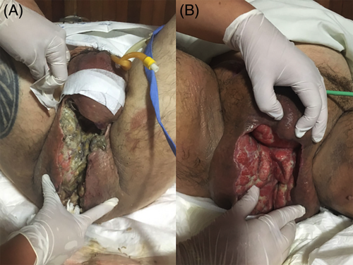 <em>Terapia larwalna zgorzeli Fourniera (metoda otwarta). Źródło zdjęcia: doi.org/</em><a style="border-color: hsl(var(--border)); border-image-source: none; --tw-border-spacing-x: 0; --tw-border-spacing-y: 0; --tw-translate-x: 0; --tw-translate-y: 0; --tw-rotate: 0; --tw-skew-x: 0; --tw-skew-y: 0; --tw-scale-x: 1; --tw-scale-y: 1; --tw-pan-x: ; --tw-pan-y: ; --tw-pinch-zoom: ; --tw-scroll-snap-strictness: proximity; --tw-gradient-from-position: ; --tw-gradient-via-position: ; --tw-gradient-to-position: ; --tw-ordinal: ; --tw-slashed-zero: ; --tw-numeric-figure: ; --tw-numeric-spacing: ; --tw-numeric-fraction: ; --tw-ring-inset: ; --tw-ring-offset-width: 0px; --tw-ring-offset-color: #fff; --tw-ring-color: rgba(59,130,246,0.5); --tw-ring-offset-shadow: 0 0 #0000; --tw-ring-shadow: 0 0 #0000; --tw-shadow: 0 0 #0000; --tw-shadow-colored: 0 0 #0000; --tw-blur: ; --tw-brightness: ; --tw-contrast: ; --tw-grayscale: ; --tw-hue-rotate: ; --tw-invert: ; --tw-saturate: ; --tw-sepia: ; --tw-drop-shadow: ; --tw-backdrop-blur: ; --tw-backdrop-brightness: ; --tw-backdrop-contrast: ; --tw-backdrop-grayscale: ; --tw-backdrop-hue-rotate: ; --tw-backdrop-invert: ; --tw-backdrop-opacity: ; --tw-backdrop-saturate: ; --tw-backdrop-sepia: ; outline-color: currentcolor; outline-style: none; text-decoration-style: solid; text-decoration-color: currentcolor;" href="http://doi.org/10.1111/iwj.13444"><span style="border-color: hsl(var(--border)); border-image-source: none; --tw-border-spacing-x: 0; --tw-border-spacing-y: 0; --tw-translate-x: 0; --tw-translate-y: 0; --tw-rotate: 0; --tw-skew-x: 0; --tw-skew-y: 0; --tw-scale-x: 1; --tw-scale-y: 1; --tw-pan-x: ; --tw-pan-y: ; --tw-pinch-zoom: ; --tw-scroll-snap-strictness: proximity; --tw-gradient-from-position: ; --tw-gradient-via-position: ; --tw-gradient-to-position: ; --tw-ordinal: ; --tw-slashed-zero: ; --tw-numeric-figure: ; --tw-numeric-spacing: ; --tw-numeric-fraction: ; --tw-ring-inset: ; --tw-ring-offset-width: 0px; --tw-ring-offset-color: #fff; --tw-ring-color: rgba(59,130,246,0.5); --tw-ring-offset-shadow: 0 0 #0000; --tw-ring-shadow: 0 0 #0000; --tw-shadow: 0 0 #0000; --tw-shadow-colored: 0 0 #0000; --tw-blur: ; --tw-brightness: ; --tw-contrast: ; --tw-grayscale: ; --tw-hue-rotate: ; --tw-invert: ; --tw-saturate: ; --tw-sepia: ; --tw-drop-shadow: ; --tw-backdrop-blur: ; --tw-backdrop-brightness: ; --tw-backdrop-contrast: ; --tw-backdrop-grayscale: ; --tw-backdrop-hue-rotate: ; --tw-backdrop-invert: ; --tw-backdrop-opacity: ; --tw-backdrop-saturate: ; --tw-backdrop-sepia: ; outline-color: currentcolor; outline-style: none; font-size: 11pt; font-family: Arial, sans-serif; color: rgb(17, 85, 204); font-style: italic; font-variant-ligatures: normal; font-variant-alternates: normal; font-variant-numeric: normal; font-variant-east-asian: normal; font-variant-position: normal; text-decoration-skip-ink: none; vertical-align: baseline; white-space: pre-wrap;"></span><em style="border-color: hsl(var(--border)); border-image-source: none; --tw-border-spacing-x: 0; --tw-border-spacing-y: 0; --tw-translate-x: 0; --tw-translate-y: 0; --tw-rotate: 0; --tw-skew-x: 0; --tw-skew-y: 0; --tw-scale-x: 1; --tw-scale-y: 1; --tw-pan-x: ; --tw-pan-y: ; --tw-pinch-zoom: ; --tw-scroll-snap-strictness: proximity; --tw-gradient-from-position: ; --tw-gradient-via-position: ; --tw-gradient-to-position: ; --tw-ordinal: ; --tw-slashed-zero: ; --tw-numeric-figure: ; --tw-numeric-spacing: ; --tw-numeric-fraction: ; --tw-ring-inset: ; --tw-ring-offset-width: 0px; --tw-ring-offset-color: #fff; --tw-ring-color: rgba(59,130,246,0.5); --tw-ring-offset-shadow: 0 0 #0000; --tw-ring-shadow: 0 0 #0000; --tw-shadow: 0 0 #0000; --tw-shadow-colored: 0 0 #0000; --tw-blur: ; --tw-brightness: ; --tw-contrast: ; --tw-grayscale: ; --tw-hue-rotate: ; --tw-invert: ; --tw-saturate: ; --tw-sepia: ; --tw-drop-shadow: ; --tw-backdrop-blur: ; --tw-backdrop-brightness: ; --tw-backdrop-contrast: ; --tw-backdrop-grayscale: ; --tw-backdrop-hue-rotate: ; --tw-backdrop-invert: ; --tw-backdrop-opacity: ; --tw-backdrop-saturate: ; --tw-backdrop-sepia: ; outline-color: currentcolor; outline-style: none;"></em><em></em><em>10.1111/iwj.13444</em></a><em></em>