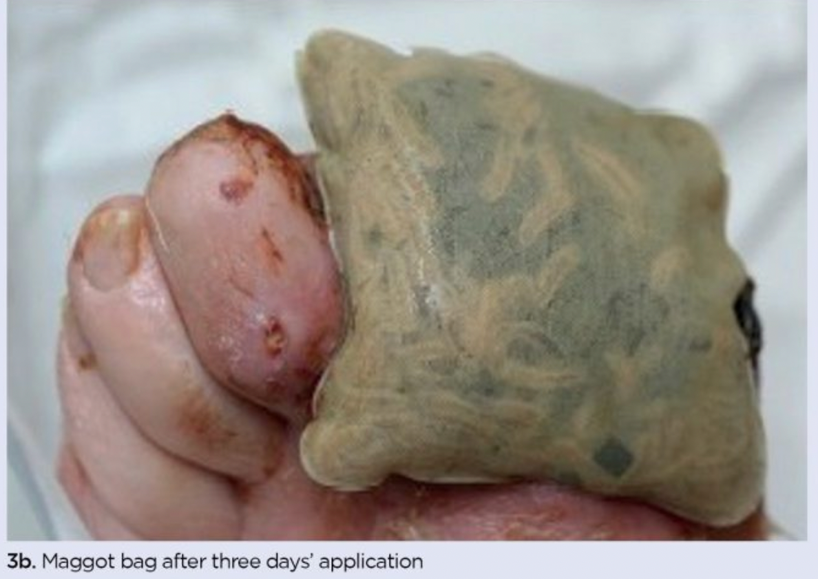 <em>Opatrunek typu biobag. Źródło zdjęcia: </em><a style="border-color: hsl(var(--border)); border-image-source: none; --tw-border-spacing-x: 0; --tw-border-spacing-y: 0; --tw-translate-x: 0; --tw-translate-y: 0; --tw-rotate: 0; --tw-skew-x: 0; --tw-skew-y: 0; --tw-scale-x: 1; --tw-scale-y: 1; --tw-pan-x: ; --tw-pan-y: ; --tw-pinch-zoom: ; --tw-scroll-snap-strictness: proximity; --tw-gradient-from-position: ; --tw-gradient-via-position: ; --tw-gradient-to-position: ; --tw-ordinal: ; --tw-slashed-zero: ; --tw-numeric-figure: ; --tw-numeric-spacing: ; --tw-numeric-fraction: ; --tw-ring-inset: ; --tw-ring-offset-width: 0px; --tw-ring-offset-color: #fff; --tw-ring-color: rgba(59,130,246,0.5); --tw-ring-offset-shadow: 0 0 #0000; --tw-ring-shadow: 0 0 #0000; --tw-shadow: 0 0 #0000; --tw-shadow-colored: 0 0 #0000; --tw-blur: ; --tw-brightness: ; --tw-contrast: ; --tw-grayscale: ; --tw-hue-rotate: ; --tw-invert: ; --tw-saturate: ; --tw-sepia: ; --tw-drop-shadow: ; --tw-backdrop-blur: ; --tw-backdrop-brightness: ; --tw-backdrop-contrast: ; --tw-backdrop-grayscale: ; --tw-backdrop-hue-rotate: ; --tw-backdrop-invert: ; --tw-backdrop-opacity: ; --tw-backdrop-saturate: ; --tw-backdrop-sepia: ; outline-color: currentcolor; outline-style: none; text-decoration-style: solid; text-decoration-color: currentcolor;" href="https://www.nursingtimes.net/tissue-viability-and-wound-care/the-principles-of-maggot-therapy-and-its-role-in-contemporary-wound-care-16-08-2021/"><span style="border-color: hsl(var(--border)); border-image-source: none; --tw-border-spacing-x: 0; --tw-border-spacing-y: 0; --tw-translate-x: 0; --tw-translate-y: 0; --tw-rotate: 0; --tw-skew-x: 0; --tw-skew-y: 0; --tw-scale-x: 1; --tw-scale-y: 1; --tw-pan-x: ; --tw-pan-y: ; --tw-pinch-zoom: ; --tw-scroll-snap-strictness: proximity; --tw-gradient-from-position: ; --tw-gradient-via-position: ; --tw-gradient-to-position: ; --tw-ordinal: ; --tw-slashed-zero: ; --tw-numeric-figure: ; --tw-numeric-spacing: ; --tw-numeric-fraction: ; --tw-ring-inset: ; --tw-ring-offset-width: 0px; --tw-ring-offset-color: #fff; --tw-ring-color: rgba(59,130,246,0.5); --tw-ring-offset-shadow: 0 0 #0000; --tw-ring-shadow: 0 0 #0000; --tw-shadow: 0 0 #0000; --tw-shadow-colored: 0 0 #0000; --tw-blur: ; --tw-brightness: ; --tw-contrast: ; --tw-grayscale: ; --tw-hue-rotate: ; --tw-invert: ; --tw-saturate: ; --tw-sepia: ; --tw-drop-shadow: ; --tw-backdrop-blur: ; --tw-backdrop-brightness: ; --tw-backdrop-contrast: ; --tw-backdrop-grayscale: ; --tw-backdrop-hue-rotate: ; --tw-backdrop-invert: ; --tw-backdrop-opacity: ; --tw-backdrop-saturate: ; --tw-backdrop-sepia: ; outline-color: currentcolor; outline-style: none; font-size: 11pt; font-family: Arial, sans-serif; color: rgb(17, 85, 204); font-style: italic; font-variant-ligatures: normal; font-variant-alternates: normal; font-variant-numeric: normal; font-variant-east-asian: normal; font-variant-position: normal; text-decoration-skip-ink: none; vertical-align: baseline; white-space: pre-wrap;"></span><em style="border-color: hsl(var(--border)); border-image-source: none; --tw-border-spacing-x: 0; --tw-border-spacing-y: 0; --tw-translate-x: 0; --tw-translate-y: 0; --tw-rotate: 0; --tw-skew-x: 0; --tw-skew-y: 0; --tw-scale-x: 1; --tw-scale-y: 1; --tw-pan-x: ; --tw-pan-y: ; --tw-pinch-zoom: ; --tw-scroll-snap-strictness: proximity; --tw-gradient-from-position: ; --tw-gradient-via-position: ; --tw-gradient-to-position: ; --tw-ordinal: ; --tw-slashed-zero: ; --tw-numeric-figure: ; --tw-numeric-spacing: ; --tw-numeric-fraction: ; --tw-ring-inset: ; --tw-ring-offset-width: 0px; --tw-ring-offset-color: #fff; --tw-ring-color: rgba(59,130,246,0.5); --tw-ring-offset-shadow: 0 0 #0000; --tw-ring-shadow: 0 0 #0000; --tw-shadow: 0 0 #0000; --tw-shadow-colored: 0 0 #0000; --tw-blur: ; --tw-brightness: ; --tw-contrast: ; --tw-grayscale: ; --tw-hue-rotate: ; --tw-invert: ; --tw-saturate: ; --tw-sepia: ; --tw-drop-shadow: ; --tw-backdrop-blur: ; --tw-backdrop-brightness: ; --tw-backdrop-contrast: ; --tw-backdrop-grayscale: ; --tw-backdrop-hue-rotate: ; --tw-backdrop-invert: ; --tw-backdrop-opacity: ; --tw-backdrop-saturate: ; --tw-backdrop-sepia: ; outline-color: currentcolor; outline-style: none;"></em><em></em><em>https://www.nursingtimes.net/tissue-viability-and-wound-care/the-principles-of-maggot-therapy-and-its-role-in-contemporary-wound-care-16-08-2021/</em></a><em></em>