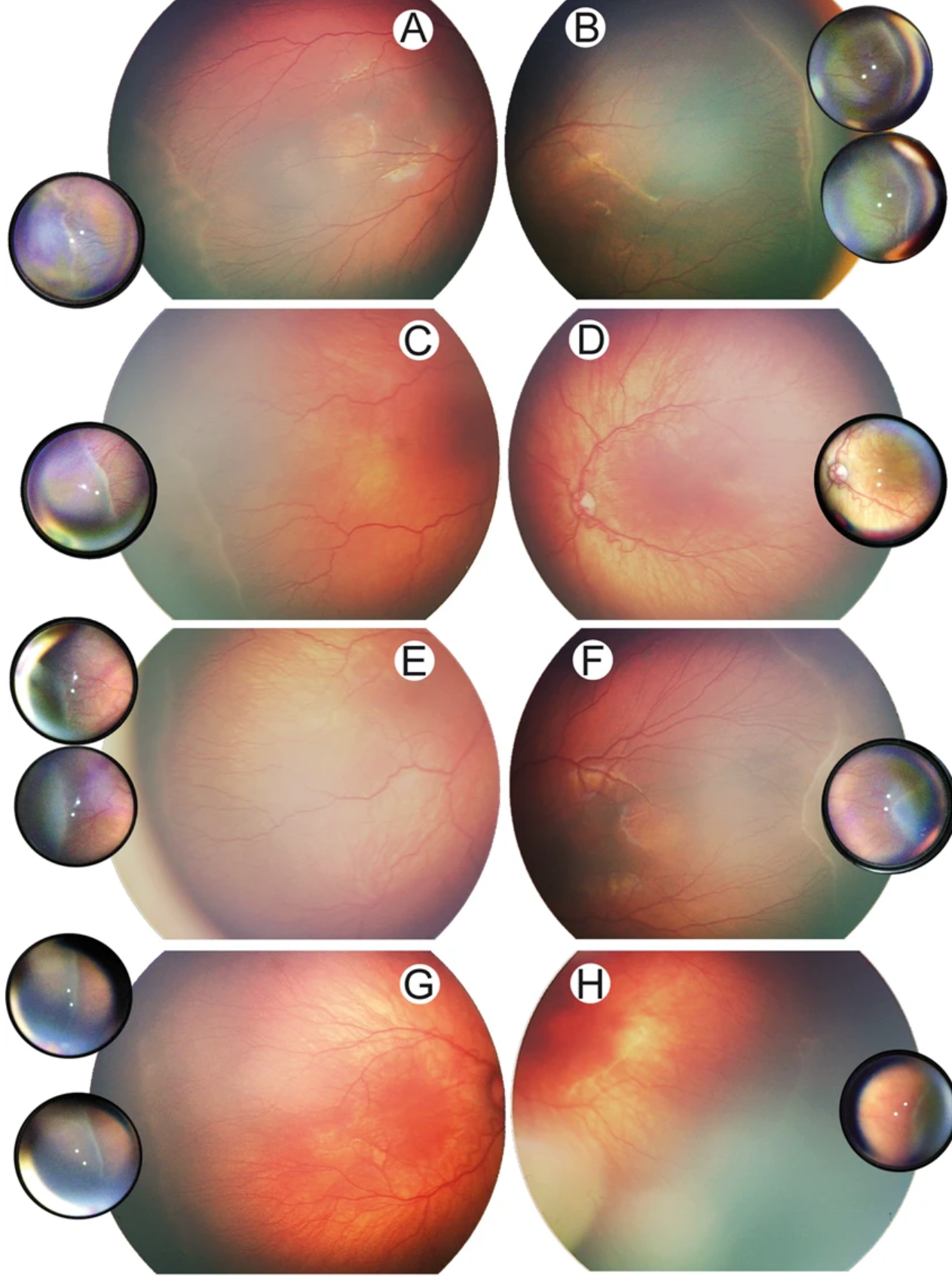 <em>źródło zdjęć: doi.org/</em><a style="border-color: hsl(var(--border)); border-image-source: none; --tw-border-spacing-x: 0; --tw-border-spacing-y: 0; --tw-translate-x: 0; --tw-translate-y: 0; --tw-rotate: 0; --tw-skew-x: 0; --tw-skew-y: 0; --tw-scale-x: 1; --tw-scale-y: 1; --tw-pan-x: ; --tw-pan-y: ; --tw-pinch-zoom: ; --tw-scroll-snap-strictness: proximity; --tw-gradient-from-position: ; --tw-gradient-via-position: ; --tw-gradient-to-position: ; --tw-ordinal: ; --tw-slashed-zero: ; --tw-numeric-figure: ; --tw-numeric-spacing: ; --tw-numeric-fraction: ; --tw-ring-inset: ; --tw-ring-offset-width: 0px; --tw-ring-offset-color: #fff; --tw-ring-color: rgba(59,130,246,0.5); --tw-ring-offset-shadow: 0 0 #0000; --tw-ring-shadow: 0 0 #0000; --tw-shadow: 0 0 #0000; --tw-shadow-colored: 0 0 #0000; --tw-blur: ; --tw-brightness: ; --tw-contrast: ; --tw-grayscale: ; --tw-hue-rotate: ; --tw-invert: ; --tw-saturate: ; --tw-sepia: ; --tw-drop-shadow: ; --tw-backdrop-blur: ; --tw-backdrop-brightness: ; --tw-backdrop-contrast: ; --tw-backdrop-grayscale: ; --tw-backdrop-hue-rotate: ; --tw-backdrop-invert: ; --tw-backdrop-opacity: ; --tw-backdrop-saturate: ; --tw-backdrop-sepia: ; outline-color: currentcolor; outline-style: none; text-decoration-style: solid; text-decoration-color: currentcolor;" href="https://doi.org/10.1038/s41598-019-56155-x"><span style="border-color: hsl(var(--border)); border-image-source: none; --tw-border-spacing-x: 0; --tw-border-spacing-y: 0; --tw-translate-x: 0; --tw-translate-y: 0; --tw-rotate: 0; --tw-skew-x: 0; --tw-skew-y: 0; --tw-scale-x: 1; --tw-scale-y: 1; --tw-pan-x: ; --tw-pan-y: ; --tw-pinch-zoom: ; --tw-scroll-snap-strictness: proximity; --tw-gradient-from-position: ; --tw-gradient-via-position: ; --tw-gradient-to-position: ; --tw-ordinal: ; --tw-slashed-zero: ; --tw-numeric-figure: ; --tw-numeric-spacing: ; --tw-numeric-fraction: ; --tw-ring-inset: ; --tw-ring-offset-width: 0px; --tw-ring-offset-color: #fff; --tw-ring-color: rgba(59,130,246,0.5); --tw-ring-offset-shadow: 0 0 #0000; --tw-ring-shadow: 0 0 #0000; --tw-shadow: 0 0 #0000; --tw-shadow-colored: 0 0 #0000; --tw-blur: ; --tw-brightness: ; --tw-contrast: ; --tw-grayscale: ; --tw-hue-rotate: ; --tw-invert: ; --tw-saturate: ; --tw-sepia: ; --tw-drop-shadow: ; --tw-backdrop-blur: ; --tw-backdrop-brightness: ; --tw-backdrop-contrast: ; --tw-backdrop-grayscale: ; --tw-backdrop-hue-rotate: ; --tw-backdrop-invert: ; --tw-backdrop-opacity: ; --tw-backdrop-saturate: ; --tw-backdrop-sepia: ; outline-color: currentcolor; outline-style: none; font-size: 10.5pt; font-family: Roboto, sans-serif; color: rgb(17, 85, 204); font-style: italic; font-variant-ligatures: normal; font-variant-alternates: normal; font-variant-numeric: normal; font-variant-east-asian: normal; font-variant-position: normal; text-decoration-skip-ink: none; vertical-align: baseline; white-space: pre-wrap;"></span><em style="border-color: hsl(var(--border)); border-image-source: none; --tw-border-spacing-x: 0; --tw-border-spacing-y: 0; --tw-translate-x: 0; --tw-translate-y: 0; --tw-rotate: 0; --tw-skew-x: 0; --tw-skew-y: 0; --tw-scale-x: 1; --tw-scale-y: 1; --tw-pan-x: ; --tw-pan-y: ; --tw-pinch-zoom: ; --tw-scroll-snap-strictness: proximity; --tw-gradient-from-position: ; --tw-gradient-via-position: ; --tw-gradient-to-position: ; --tw-ordinal: ; --tw-slashed-zero: ; --tw-numeric-figure: ; --tw-numeric-spacing: ; --tw-numeric-fraction: ; --tw-ring-inset: ; --tw-ring-offset-width: 0px; --tw-ring-offset-color: #fff; --tw-ring-color: rgba(59,130,246,0.5); --tw-ring-offset-shadow: 0 0 #0000; --tw-ring-shadow: 0 0 #0000; --tw-shadow: 0 0 #0000; --tw-shadow-colored: 0 0 #0000; --tw-blur: ; --tw-brightness: ; --tw-contrast: ; --tw-grayscale: ; --tw-hue-rotate: ; --tw-invert: ; --tw-saturate: ; --tw-sepia: ; --tw-drop-shadow: ; --tw-backdrop-blur: ; --tw-backdrop-brightness: ; --tw-backdrop-contrast: ; --tw-backdrop-grayscale: ; --tw-backdrop-hue-rotate: ; --tw-backdrop-invert: ; --tw-backdrop-opacity: ; --tw-backdrop-saturate: ; --tw-backdrop-sepia: ; outline-color: currentcolor; outline-style: none;"></em><em></em><em>10.1038/s41598-019-56155-x</em></a>