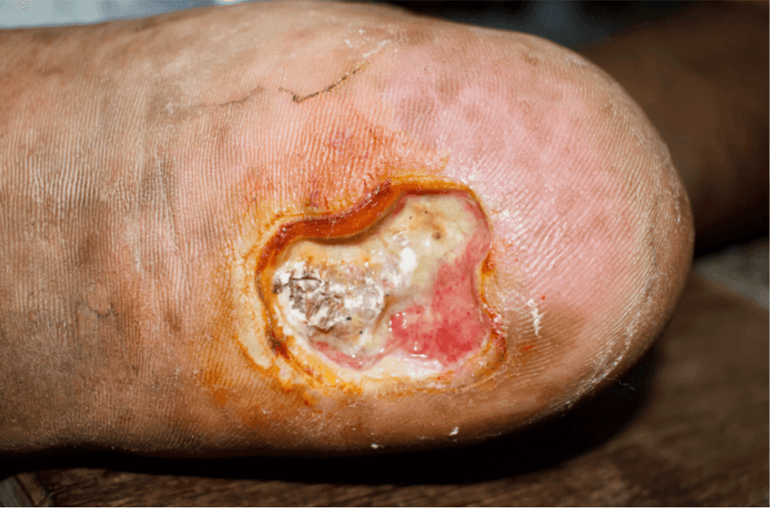 <em>źródło zdjęcia: </em><a style="border-color: hsl(var(--border)); border-image-source: none; --tw-border-spacing-x: 0; --tw-border-spacing-y: 0; --tw-translate-x: 0; --tw-translate-y: 0; --tw-rotate: 0; --tw-skew-x: 0; --tw-skew-y: 0; --tw-scale-x: 1; --tw-scale-y: 1; --tw-pan-x: ; --tw-pan-y: ; --tw-pinch-zoom: ; --tw-scroll-snap-strictness: proximity; --tw-gradient-from-position: ; --tw-gradient-via-position: ; --tw-gradient-to-position: ; --tw-ordinal: ; --tw-slashed-zero: ; --tw-numeric-figure: ; --tw-numeric-spacing: ; --tw-numeric-fraction: ; --tw-ring-inset: ; --tw-ring-offset-width: 0px; --tw-ring-offset-color: #fff; --tw-ring-color: rgba(59,130,246,0.5); --tw-ring-offset-shadow: 0 0 #0000; --tw-ring-shadow: 0 0 #0000; --tw-shadow: 0 0 #0000; --tw-shadow-colored: 0 0 #0000; --tw-blur: ; --tw-brightness: ; --tw-contrast: ; --tw-grayscale: ; --tw-hue-rotate: ; --tw-invert: ; --tw-saturate: ; --tw-sepia: ; --tw-drop-shadow: ; --tw-backdrop-blur: ; --tw-backdrop-brightness: ; --tw-backdrop-contrast: ; --tw-backdrop-grayscale: ; --tw-backdrop-hue-rotate: ; --tw-backdrop-invert: ; --tw-backdrop-opacity: ; --tw-backdrop-saturate: ; --tw-backdrop-sepia: ; outline-color: currentcolor; outline-style: none; text-decoration-style: solid; text-decoration-color: currentcolor;" href="https://provascularmd.com/arterial-ulcer-pictures/"><span style="border-color: hsl(var(--border)); border-image-source: none; --tw-border-spacing-x: 0; --tw-border-spacing-y: 0; --tw-translate-x: 0; --tw-translate-y: 0; --tw-rotate: 0; --tw-skew-x: 0; --tw-skew-y: 0; --tw-scale-x: 1; --tw-scale-y: 1; --tw-pan-x: ; --tw-pan-y: ; --tw-pinch-zoom: ; --tw-scroll-snap-strictness: proximity; --tw-gradient-from-position: ; --tw-gradient-via-position: ; --tw-gradient-to-position: ; --tw-ordinal: ; --tw-slashed-zero: ; --tw-numeric-figure: ; --tw-numeric-spacing: ; --tw-numeric-fraction: ; --tw-ring-inset: ; --tw-ring-offset-width: 0px; --tw-ring-offset-color: #fff; --tw-ring-color: rgba(59,130,246,0.5); --tw-ring-offset-shadow: 0 0 #0000; --tw-ring-shadow: 0 0 #0000; --tw-shadow: 0 0 #0000; --tw-shadow-colored: 0 0 #0000; --tw-blur: ; --tw-brightness: ; --tw-contrast: ; --tw-grayscale: ; --tw-hue-rotate: ; --tw-invert: ; --tw-saturate: ; --tw-sepia: ; --tw-drop-shadow: ; --tw-backdrop-blur: ; --tw-backdrop-brightness: ; --tw-backdrop-contrast: ; --tw-backdrop-grayscale: ; --tw-backdrop-hue-rotate: ; --tw-backdrop-invert: ; --tw-backdrop-opacity: ; --tw-backdrop-saturate: ; --tw-backdrop-sepia: ; outline-color: currentcolor; outline-style: none; font-size: 12pt; font-family: "Times New Roman", serif; color: rgb(17, 85, 204); font-style: italic; font-variant-ligatures: normal; font-variant-alternates: normal; font-variant-numeric: normal; font-variant-east-asian: normal; font-variant-position: normal; text-decoration-skip-ink: none; vertical-align: baseline; white-space: pre-wrap;"></span><em style="border-color: hsl(var(--border)); border-image-source: none; --tw-border-spacing-x: 0; --tw-border-spacing-y: 0; --tw-translate-x: 0; --tw-translate-y: 0; --tw-rotate: 0; --tw-skew-x: 0; --tw-skew-y: 0; --tw-scale-x: 1; --tw-scale-y: 1; --tw-pan-x: ; --tw-pan-y: ; --tw-pinch-zoom: ; --tw-scroll-snap-strictness: proximity; --tw-gradient-from-position: ; --tw-gradient-via-position: ; --tw-gradient-to-position: ; --tw-ordinal: ; --tw-slashed-zero: ; --tw-numeric-figure: ; --tw-numeric-spacing: ; --tw-numeric-fraction: ; --tw-ring-inset: ; --tw-ring-offset-width: 0px; --tw-ring-offset-color: #fff; --tw-ring-color: rgba(59,130,246,0.5); --tw-ring-offset-shadow: 0 0 #0000; --tw-ring-shadow: 0 0 #0000; --tw-shadow: 0 0 #0000; --tw-shadow-colored: 0 0 #0000; --tw-blur: ; --tw-brightness: ; --tw-contrast: ; --tw-grayscale: ; --tw-hue-rotate: ; --tw-invert: ; --tw-saturate: ; --tw-sepia: ; --tw-drop-shadow: ; --tw-backdrop-blur: ; --tw-backdrop-brightness: ; --tw-backdrop-contrast: ; --tw-backdrop-grayscale: ; --tw-backdrop-hue-rotate: ; --tw-backdrop-invert: ; --tw-backdrop-opacity: ; --tw-backdrop-saturate: ; --tw-backdrop-sepia: ; outline-color: currentcolor; outline-style: none;"></em><em></em><em>https://provascularmd.com/arterial-ulcer-pictures/</em></a><em></em>