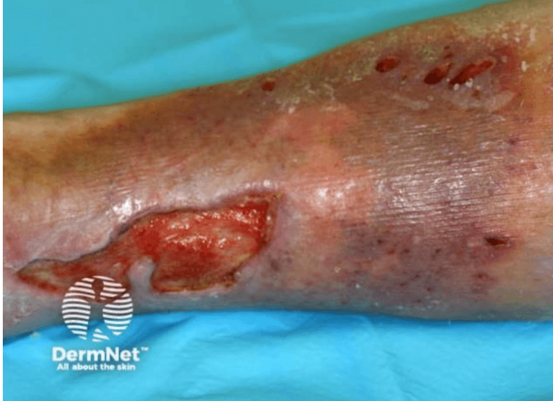<em>źródło zdjęcia: </em><a style="border-color: hsl(var(--border)); border-image-source: none; --tw-border-spacing-x: 0; --tw-border-spacing-y: 0; --tw-translate-x: 0; --tw-translate-y: 0; --tw-rotate: 0; --tw-skew-x: 0; --tw-skew-y: 0; --tw-scale-x: 1; --tw-scale-y: 1; --tw-pan-x: ; --tw-pan-y: ; --tw-pinch-zoom: ; --tw-scroll-snap-strictness: proximity; --tw-gradient-from-position: ; --tw-gradient-via-position: ; --tw-gradient-to-position: ; --tw-ordinal: ; --tw-slashed-zero: ; --tw-numeric-figure: ; --tw-numeric-spacing: ; --tw-numeric-fraction: ; --tw-ring-inset: ; --tw-ring-offset-width: 0px; --tw-ring-offset-color: #fff; --tw-ring-color: rgba(59,130,246,0.5); --tw-ring-offset-shadow: 0 0 #0000; --tw-ring-shadow: 0 0 #0000; --tw-shadow: 0 0 #0000; --tw-shadow-colored: 0 0 #0000; --tw-blur: ; --tw-brightness: ; --tw-contrast: ; --tw-grayscale: ; --tw-hue-rotate: ; --tw-invert: ; --tw-saturate: ; --tw-sepia: ; --tw-drop-shadow: ; --tw-backdrop-blur: ; --tw-backdrop-brightness: ; --tw-backdrop-contrast: ; --tw-backdrop-grayscale: ; --tw-backdrop-hue-rotate: ; --tw-backdrop-invert: ; --tw-backdrop-opacity: ; --tw-backdrop-saturate: ; --tw-backdrop-sepia: ; outline-color: currentcolor; outline-style: none; text-decoration-style: solid; text-decoration-color: currentcolor;" href="https://dermnetnz.org/assets/Uploads/venous-ulcer-03.jpg"><span style="border-color: hsl(var(--border)); border-image-source: none; --tw-border-spacing-x: 0; --tw-border-spacing-y: 0; --tw-translate-x: 0; --tw-translate-y: 0; --tw-rotate: 0; --tw-skew-x: 0; --tw-skew-y: 0; --tw-scale-x: 1; --tw-scale-y: 1; --tw-pan-x: ; --tw-pan-y: ; --tw-pinch-zoom: ; --tw-scroll-snap-strictness: proximity; --tw-gradient-from-position: ; --tw-gradient-via-position: ; --tw-gradient-to-position: ; --tw-ordinal: ; --tw-slashed-zero: ; --tw-numeric-figure: ; --tw-numeric-spacing: ; --tw-numeric-fraction: ; --tw-ring-inset: ; --tw-ring-offset-width: 0px; --tw-ring-offset-color: #fff; --tw-ring-color: rgba(59,130,246,0.5); --tw-ring-offset-shadow: 0 0 #0000; --tw-ring-shadow: 0 0 #0000; --tw-shadow: 0 0 #0000; --tw-shadow-colored: 0 0 #0000; --tw-blur: ; --tw-brightness: ; --tw-contrast: ; --tw-grayscale: ; --tw-hue-rotate: ; --tw-invert: ; --tw-saturate: ; --tw-sepia: ; --tw-drop-shadow: ; --tw-backdrop-blur: ; --tw-backdrop-brightness: ; --tw-backdrop-contrast: ; --tw-backdrop-grayscale: ; --tw-backdrop-hue-rotate: ; --tw-backdrop-invert: ; --tw-backdrop-opacity: ; --tw-backdrop-saturate: ; --tw-backdrop-sepia: ; outline-color: currentcolor; outline-style: none; font-size: 12pt; font-family: "Times New Roman", serif; color: rgb(17, 85, 204); font-style: italic; font-variant-ligatures: normal; font-variant-alternates: normal; font-variant-numeric: normal; font-variant-east-asian: normal; font-variant-position: normal; text-decoration-skip-ink: none; vertical-align: baseline; white-space: pre-wrap;"></span><em style="border-color: hsl(var(--border)); border-image-source: none; --tw-border-spacing-x: 0; --tw-border-spacing-y: 0; --tw-translate-x: 0; --tw-translate-y: 0; --tw-rotate: 0; --tw-skew-x: 0; --tw-skew-y: 0; --tw-scale-x: 1; --tw-scale-y: 1; --tw-pan-x: ; --tw-pan-y: ; --tw-pinch-zoom: ; --tw-scroll-snap-strictness: proximity; --tw-gradient-from-position: ; --tw-gradient-via-position: ; --tw-gradient-to-position: ; --tw-ordinal: ; --tw-slashed-zero: ; --tw-numeric-figure: ; --tw-numeric-spacing: ; --tw-numeric-fraction: ; --tw-ring-inset: ; --tw-ring-offset-width: 0px; --tw-ring-offset-color: #fff; --tw-ring-color: rgba(59,130,246,0.5); --tw-ring-offset-shadow: 0 0 #0000; --tw-ring-shadow: 0 0 #0000; --tw-shadow: 0 0 #0000; --tw-shadow-colored: 0 0 #0000; --tw-blur: ; --tw-brightness: ; --tw-contrast: ; --tw-grayscale: ; --tw-hue-rotate: ; --tw-invert: ; --tw-saturate: ; --tw-sepia: ; --tw-drop-shadow: ; --tw-backdrop-blur: ; --tw-backdrop-brightness: ; --tw-backdrop-contrast: ; --tw-backdrop-grayscale: ; --tw-backdrop-hue-rotate: ; --tw-backdrop-invert: ; --tw-backdrop-opacity: ; --tw-backdrop-saturate: ; --tw-backdrop-sepia: ; outline-color: currentcolor; outline-style: none;"></em><em></em><em>https://dermnetnz.org/assets/Uploads/venous-ulcer-03.jpg</em></a><em></em>