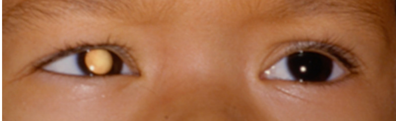 <em>źródło zdjęcia: </em><a style="--tw-border-spacing-x: 0; --tw-border-spacing-y: 0; --tw-translate-x: 0; --tw-translate-y: 0; --tw-rotate: 0; --tw-skew-x: 0; --tw-skew-y: 0; --tw-scale-x: 1; --tw-scale-y: 1; --tw-pan-x: ; --tw-pan-y: ; --tw-pinch-zoom: ; --tw-scroll-snap-strictness: proximity; --tw-gradient-from-position: ; --tw-gradient-via-position: ; --tw-gradient-to-position: ; --tw-ordinal: ; --tw-slashed-zero: ; --tw-numeric-figure: ; --tw-numeric-spacing: ; --tw-numeric-fraction: ; --tw-ring-inset: ; --tw-ring-offset-width: 0px; --tw-ring-offset-color: #fff; --tw-ring-color: rgba(59,130,246,0.5); --tw-ring-offset-shadow: 0 0 #0000; --tw-ring-shadow: 0 0 #0000; --tw-shadow: 0 0 #0000; --tw-shadow-colored: 0 0 #0000; --tw-blur: ; --tw-brightness: ; --tw-contrast: ; --tw-grayscale: ; --tw-hue-rotate: ; --tw-invert: ; --tw-saturate: ; --tw-sepia: ; --tw-drop-shadow: ; --tw-backdrop-blur: ; --tw-backdrop-brightness: ; --tw-backdrop-contrast: ; --tw-backdrop-grayscale: ; --tw-backdrop-hue-rotate: ; --tw-backdrop-invert: ; --tw-backdrop-opacity: ; --tw-backdrop-saturate: ; --tw-backdrop-sepia: ; border-color: hsl(var(--border)); border-image-source: none; outline-color: currentcolor; outline-style: none; text-decoration-style: solid; text-decoration-color: currentcolor;" href="https://www.ncbi.nlm.nih.gov/books/NBK597373/figure/article-144063.image.f2/"><span style="--tw-border-spacing-x: 0; --tw-border-spacing-y: 0; --tw-translate-x: 0; --tw-translate-y: 0; --tw-rotate: 0; --tw-skew-x: 0; --tw-skew-y: 0; --tw-scale-x: 1; --tw-scale-y: 1; --tw-pan-x: ; --tw-pan-y: ; --tw-pinch-zoom: ; --tw-scroll-snap-strictness: proximity; --tw-gradient-from-position: ; --tw-gradient-via-position: ; --tw-gradient-to-position: ; --tw-ordinal: ; --tw-slashed-zero: ; --tw-numeric-figure: ; --tw-numeric-spacing: ; --tw-numeric-fraction: ; --tw-ring-inset: ; --tw-ring-offset-width: 0px; --tw-ring-offset-color: #fff; --tw-ring-color: rgba(59,130,246,0.5); --tw-ring-offset-shadow: 0 0 #0000; --tw-ring-shadow: 0 0 #0000; --tw-shadow: 0 0 #0000; --tw-shadow-colored: 0 0 #0000; --tw-blur: ; --tw-brightness: ; --tw-contrast: ; --tw-grayscale: ; --tw-hue-rotate: ; --tw-invert: ; --tw-saturate: ; --tw-sepia: ; --tw-drop-shadow: ; --tw-backdrop-blur: ; --tw-backdrop-brightness: ; --tw-backdrop-contrast: ; --tw-backdrop-grayscale: ; --tw-backdrop-hue-rotate: ; --tw-backdrop-invert: ; --tw-backdrop-opacity: ; --tw-backdrop-saturate: ; --tw-backdrop-sepia: ; border-color: hsl(var(--border)); border-image-source: none; outline-color: currentcolor; outline-style: none; font-size: 11pt; font-family: Arial, sans-serif; color: rgb(17, 85, 204); font-style: italic; font-variant-ligatures: normal; font-variant-alternates: normal; font-variant-numeric: normal; font-variant-east-asian: normal; font-variant-position: normal; text-decoration-skip-ink: none; vertical-align: baseline; white-space: pre-wrap;"></span><em style="--tw-border-spacing-x: 0; --tw-border-spacing-y: 0; --tw-translate-x: 0; --tw-translate-y: 0; --tw-rotate: 0; --tw-skew-x: 0; --tw-skew-y: 0; --tw-scale-x: 1; --tw-scale-y: 1; --tw-pan-x: ; --tw-pan-y: ; --tw-pinch-zoom: ; --tw-scroll-snap-strictness: proximity; --tw-gradient-from-position: ; --tw-gradient-via-position: ; --tw-gradient-to-position: ; --tw-ordinal: ; --tw-slashed-zero: ; --tw-numeric-figure: ; --tw-numeric-spacing: ; --tw-numeric-fraction: ; --tw-ring-inset: ; --tw-ring-offset-width: 0px; --tw-ring-offset-color: #fff; --tw-ring-color: rgba(59,130,246,0.5); --tw-ring-offset-shadow: 0 0 #0000; --tw-ring-shadow: 0 0 #0000; --tw-shadow: 0 0 #0000; --tw-shadow-colored: 0 0 #0000; --tw-blur: ; --tw-brightness: ; --tw-contrast: ; --tw-grayscale: ; --tw-hue-rotate: ; --tw-invert: ; --tw-saturate: ; --tw-sepia: ; --tw-drop-shadow: ; --tw-backdrop-blur: ; --tw-backdrop-brightness: ; --tw-backdrop-contrast: ; --tw-backdrop-grayscale: ; --tw-backdrop-hue-rotate: ; --tw-backdrop-invert: ; --tw-backdrop-opacity: ; --tw-backdrop-saturate: ; --tw-backdrop-sepia: ; border-color: hsl(var(--border)); border-image-source: none; outline-color: currentcolor; outline-style: none;"></em><em></em><em>https://www.ncbi.nlm.nih.gov/books/NBK597373/figure/article-144063.image.f2/</em></a><em></em>