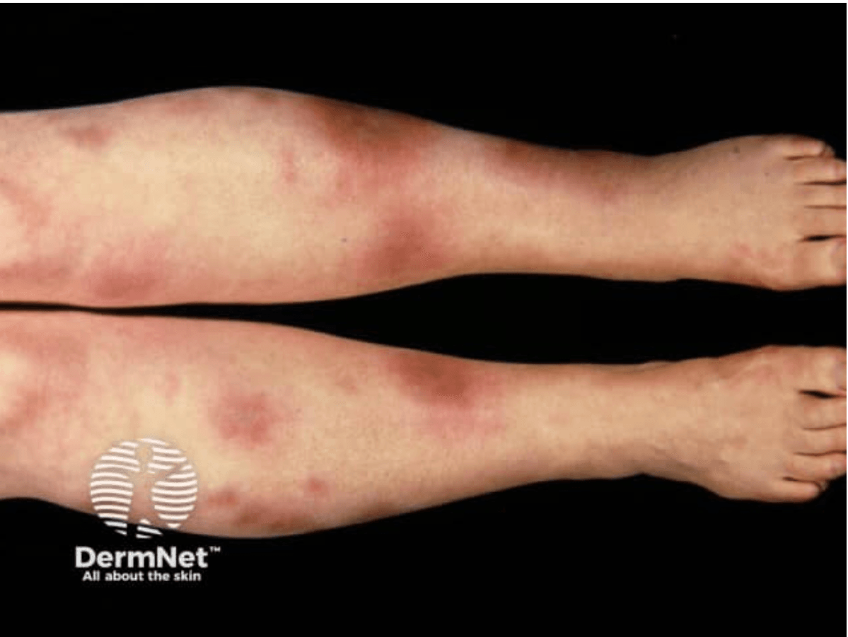 <em>źródło zdjęcia: </em><a style="--tw-border-spacing-x: 0; --tw-border-spacing-y: 0; --tw-translate-x: 0; --tw-translate-y: 0; --tw-rotate: 0; --tw-skew-x: 0; --tw-skew-y: 0; --tw-scale-x: 1; --tw-scale-y: 1; --tw-pan-x: ; --tw-pan-y: ; --tw-pinch-zoom: ; --tw-scroll-snap-strictness: proximity; --tw-gradient-from-position: ; --tw-gradient-via-position: ; --tw-gradient-to-position: ; --tw-ordinal: ; --tw-slashed-zero: ; --tw-numeric-figure: ; --tw-numeric-spacing: ; --tw-numeric-fraction: ; --tw-ring-inset: ; --tw-ring-offset-width: 0px; --tw-ring-offset-color: #fff; --tw-ring-color: rgba(59,130,246,0.5); --tw-ring-offset-shadow: 0 0 #0000; --tw-ring-shadow: 0 0 #0000; --tw-shadow: 0 0 #0000; --tw-shadow-colored: 0 0 #0000; --tw-blur: ; --tw-brightness: ; --tw-contrast: ; --tw-grayscale: ; --tw-hue-rotate: ; --tw-invert: ; --tw-saturate: ; --tw-sepia: ; --tw-drop-shadow: ; --tw-backdrop-blur: ; --tw-backdrop-brightness: ; --tw-backdrop-contrast: ; --tw-backdrop-grayscale: ; --tw-backdrop-hue-rotate: ; --tw-backdrop-invert: ; --tw-backdrop-opacity: ; --tw-backdrop-saturate: ; --tw-backdrop-sepia: ; border-color: hsl(var(--border)); border-image-source: none; outline-color: currentcolor; outline-style: none; text-decoration-style: solid; text-decoration-color: currentcolor;" href="https://dermnetnz.org/assets/Uploads/vascular/en3.jpg"><span style="--tw-border-spacing-x: 0; --tw-border-spacing-y: 0; --tw-translate-x: 0; --tw-translate-y: 0; --tw-rotate: 0; --tw-skew-x: 0; --tw-skew-y: 0; --tw-scale-x: 1; --tw-scale-y: 1; --tw-pan-x: ; --tw-pan-y: ; --tw-pinch-zoom: ; --tw-scroll-snap-strictness: proximity; --tw-gradient-from-position: ; --tw-gradient-via-position: ; --tw-gradient-to-position: ; --tw-ordinal: ; --tw-slashed-zero: ; --tw-numeric-figure: ; --tw-numeric-spacing: ; --tw-numeric-fraction: ; --tw-ring-inset: ; --tw-ring-offset-width: 0px; --tw-ring-offset-color: #fff; --tw-ring-color: rgba(59,130,246,0.5); --tw-ring-offset-shadow: 0 0 #0000; --tw-ring-shadow: 0 0 #0000; --tw-shadow: 0 0 #0000; --tw-shadow-colored: 0 0 #0000; --tw-blur: ; --tw-brightness: ; --tw-contrast: ; --tw-grayscale: ; --tw-hue-rotate: ; --tw-invert: ; --tw-saturate: ; --tw-sepia: ; --tw-drop-shadow: ; --tw-backdrop-blur: ; --tw-backdrop-brightness: ; --tw-backdrop-contrast: ; --tw-backdrop-grayscale: ; --tw-backdrop-hue-rotate: ; --tw-backdrop-invert: ; --tw-backdrop-opacity: ; --tw-backdrop-saturate: ; --tw-backdrop-sepia: ; border-color: hsl(var(--border)); border-image-source: none; outline-color: currentcolor; outline-style: none; font-size: 11pt; font-family: Arial, sans-serif; color: rgb(17, 85, 204); font-style: italic; font-variant-ligatures: normal; font-variant-alternates: normal; font-variant-numeric: normal; font-variant-east-asian: normal; font-variant-position: normal; text-decoration-skip-ink: none; vertical-align: baseline; white-space: pre-wrap;"></span><em style="--tw-border-spacing-x: 0; --tw-border-spacing-y: 0; --tw-translate-x: 0; --tw-translate-y: 0; --tw-rotate: 0; --tw-skew-x: 0; --tw-skew-y: 0; --tw-scale-x: 1; --tw-scale-y: 1; --tw-pan-x: ; --tw-pan-y: ; --tw-pinch-zoom: ; --tw-scroll-snap-strictness: proximity; --tw-gradient-from-position: ; --tw-gradient-via-position: ; --tw-gradient-to-position: ; --tw-ordinal: ; --tw-slashed-zero: ; --tw-numeric-figure: ; --tw-numeric-spacing: ; --tw-numeric-fraction: ; --tw-ring-inset: ; --tw-ring-offset-width: 0px; --tw-ring-offset-color: #fff; --tw-ring-color: rgba(59,130,246,0.5); --tw-ring-offset-shadow: 0 0 #0000; --tw-ring-shadow: 0 0 #0000; --tw-shadow: 0 0 #0000; --tw-shadow-colored: 0 0 #0000; --tw-blur: ; --tw-brightness: ; --tw-contrast: ; --tw-grayscale: ; --tw-hue-rotate: ; --tw-invert: ; --tw-saturate: ; --tw-sepia: ; --tw-drop-shadow: ; --tw-backdrop-blur: ; --tw-backdrop-brightness: ; --tw-backdrop-contrast: ; --tw-backdrop-grayscale: ; --tw-backdrop-hue-rotate: ; --tw-backdrop-invert: ; --tw-backdrop-opacity: ; --tw-backdrop-saturate: ; --tw-backdrop-sepia: ; border-color: hsl(var(--border)); border-image-source: none; outline-color: currentcolor; outline-style: none;"></em><em></em><em>https://dermnetnz.org/assets/Uploads/vascular/en3.jpg</em></a><em></em>