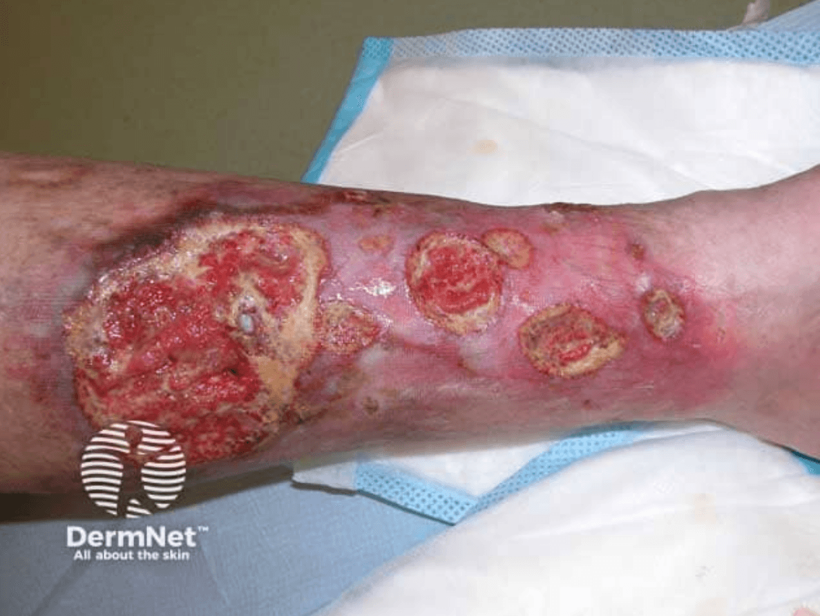 <em>źródło zdjęcia: </em><a style="--tw-border-spacing-x: 0; --tw-border-spacing-y: 0; --tw-translate-x: 0; --tw-translate-y: 0; --tw-rotate: 0; --tw-skew-x: 0; --tw-skew-y: 0; --tw-scale-x: 1; --tw-scale-y: 1; --tw-pan-x: ; --tw-pan-y: ; --tw-pinch-zoom: ; --tw-scroll-snap-strictness: proximity; --tw-gradient-from-position: ; --tw-gradient-via-position: ; --tw-gradient-to-position: ; --tw-ordinal: ; --tw-slashed-zero: ; --tw-numeric-figure: ; --tw-numeric-spacing: ; --tw-numeric-fraction: ; --tw-ring-inset: ; --tw-ring-offset-width: 0px; --tw-ring-offset-color: #fff; --tw-ring-color: rgba(59,130,246,0.5); --tw-ring-offset-shadow: 0 0 #0000; --tw-ring-shadow: 0 0 #0000; --tw-shadow: 0 0 #0000; --tw-shadow-colored: 0 0 #0000; --tw-blur: ; --tw-brightness: ; --tw-contrast: ; --tw-grayscale: ; --tw-hue-rotate: ; --tw-invert: ; --tw-saturate: ; --tw-sepia: ; --tw-drop-shadow: ; --tw-backdrop-blur: ; --tw-backdrop-brightness: ; --tw-backdrop-contrast: ; --tw-backdrop-grayscale: ; --tw-backdrop-hue-rotate: ; --tw-backdrop-invert: ; --tw-backdrop-opacity: ; --tw-backdrop-saturate: ; --tw-backdrop-sepia: ; border-color: hsl(var(--border)); border-image-source: none; outline-color: currentcolor; outline-style: none; text-decoration-style: solid; text-decoration-color: currentcolor;" href="https://dermnetnz.org/imagedetail/1390-pyoderma-gangrenosum"><span style="--tw-border-spacing-x: 0; --tw-border-spacing-y: 0; --tw-translate-x: 0; --tw-translate-y: 0; --tw-rotate: 0; --tw-skew-x: 0; --tw-skew-y: 0; --tw-scale-x: 1; --tw-scale-y: 1; --tw-pan-x: ; --tw-pan-y: ; --tw-pinch-zoom: ; --tw-scroll-snap-strictness: proximity; --tw-gradient-from-position: ; --tw-gradient-via-position: ; --tw-gradient-to-position: ; --tw-ordinal: ; --tw-slashed-zero: ; --tw-numeric-figure: ; --tw-numeric-spacing: ; --tw-numeric-fraction: ; --tw-ring-inset: ; --tw-ring-offset-width: 0px; --tw-ring-offset-color: #fff; --tw-ring-color: rgba(59,130,246,0.5); --tw-ring-offset-shadow: 0 0 #0000; --tw-ring-shadow: 0 0 #0000; --tw-shadow: 0 0 #0000; --tw-shadow-colored: 0 0 #0000; --tw-blur: ; --tw-brightness: ; --tw-contrast: ; --tw-grayscale: ; --tw-hue-rotate: ; --tw-invert: ; --tw-saturate: ; --tw-sepia: ; --tw-drop-shadow: ; --tw-backdrop-blur: ; --tw-backdrop-brightness: ; --tw-backdrop-contrast: ; --tw-backdrop-grayscale: ; --tw-backdrop-hue-rotate: ; --tw-backdrop-invert: ; --tw-backdrop-opacity: ; --tw-backdrop-saturate: ; --tw-backdrop-sepia: ; border-color: hsl(var(--border)); border-image-source: none; outline-color: currentcolor; outline-style: none; font-size: 11pt; font-family: Arial, sans-serif; color: rgb(17, 85, 204); font-style: italic; font-variant-ligatures: normal; font-variant-alternates: normal; font-variant-numeric: normal; font-variant-east-asian: normal; font-variant-position: normal; text-decoration-skip-ink: none; vertical-align: baseline; white-space: pre-wrap;"></span><em style="--tw-border-spacing-x: 0; --tw-border-spacing-y: 0; --tw-translate-x: 0; --tw-translate-y: 0; --tw-rotate: 0; --tw-skew-x: 0; --tw-skew-y: 0; --tw-scale-x: 1; --tw-scale-y: 1; --tw-pan-x: ; --tw-pan-y: ; --tw-pinch-zoom: ; --tw-scroll-snap-strictness: proximity; --tw-gradient-from-position: ; --tw-gradient-via-position: ; --tw-gradient-to-position: ; --tw-ordinal: ; --tw-slashed-zero: ; --tw-numeric-figure: ; --tw-numeric-spacing: ; --tw-numeric-fraction: ; --tw-ring-inset: ; --tw-ring-offset-width: 0px; --tw-ring-offset-color: #fff; --tw-ring-color: rgba(59,130,246,0.5); --tw-ring-offset-shadow: 0 0 #0000; --tw-ring-shadow: 0 0 #0000; --tw-shadow: 0 0 #0000; --tw-shadow-colored: 0 0 #0000; --tw-blur: ; --tw-brightness: ; --tw-contrast: ; --tw-grayscale: ; --tw-hue-rotate: ; --tw-invert: ; --tw-saturate: ; --tw-sepia: ; --tw-drop-shadow: ; --tw-backdrop-blur: ; --tw-backdrop-brightness: ; --tw-backdrop-contrast: ; --tw-backdrop-grayscale: ; --tw-backdrop-hue-rotate: ; --tw-backdrop-invert: ; --tw-backdrop-opacity: ; --tw-backdrop-saturate: ; --tw-backdrop-sepia: ; border-color: hsl(var(--border)); border-image-source: none; outline-color: currentcolor; outline-style: none;"></em><em></em><em>https://dermnetnz.org/imagedetail/1390-pyoderma-gangrenosum</em></a><em></em>