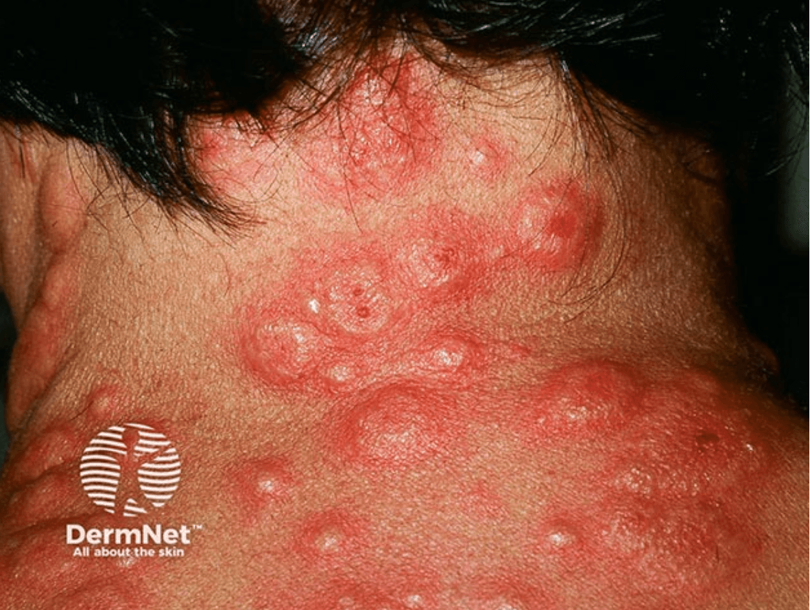 <em>źródło zdjęcia: </em><a style="--tw-border-spacing-x: 0; --tw-border-spacing-y: 0; --tw-translate-x: 0; --tw-translate-y: 0; --tw-rotate: 0; --tw-skew-x: 0; --tw-skew-y: 0; --tw-scale-x: 1; --tw-scale-y: 1; --tw-pan-x: ; --tw-pan-y: ; --tw-pinch-zoom: ; --tw-scroll-snap-strictness: proximity; --tw-gradient-from-position: ; --tw-gradient-via-position: ; --tw-gradient-to-position: ; --tw-ordinal: ; --tw-slashed-zero: ; --tw-numeric-figure: ; --tw-numeric-spacing: ; --tw-numeric-fraction: ; --tw-ring-inset: ; --tw-ring-offset-width: 0px; --tw-ring-offset-color: #fff; --tw-ring-color: rgba(59,130,246,0.5); --tw-ring-offset-shadow: 0 0 #0000; --tw-ring-shadow: 0 0 #0000; --tw-shadow: 0 0 #0000; --tw-shadow-colored: 0 0 #0000; --tw-blur: ; --tw-brightness: ; --tw-contrast: ; --tw-grayscale: ; --tw-hue-rotate: ; --tw-invert: ; --tw-saturate: ; --tw-sepia: ; --tw-drop-shadow: ; --tw-backdrop-blur: ; --tw-backdrop-brightness: ; --tw-backdrop-contrast: ; --tw-backdrop-grayscale: ; --tw-backdrop-hue-rotate: ; --tw-backdrop-invert: ; --tw-backdrop-opacity: ; --tw-backdrop-saturate: ; --tw-backdrop-sepia: ; border-color: hsl(var(--border)); border-image-source: none; outline-color: currentcolor; outline-style: none; text-decoration-style: solid; text-decoration-color: currentcolor;" href="https://dermnetnz.org/imagedetail/24265-acute-febrile-neutrophilic-dermatosis"><span style="--tw-border-spacing-x: 0; --tw-border-spacing-y: 0; --tw-translate-x: 0; --tw-translate-y: 0; --tw-rotate: 0; --tw-skew-x: 0; --tw-skew-y: 0; --tw-scale-x: 1; --tw-scale-y: 1; --tw-pan-x: ; --tw-pan-y: ; --tw-pinch-zoom: ; --tw-scroll-snap-strictness: proximity; --tw-gradient-from-position: ; --tw-gradient-via-position: ; --tw-gradient-to-position: ; --tw-ordinal: ; --tw-slashed-zero: ; --tw-numeric-figure: ; --tw-numeric-spacing: ; --tw-numeric-fraction: ; --tw-ring-inset: ; --tw-ring-offset-width: 0px; --tw-ring-offset-color: #fff; --tw-ring-color: rgba(59,130,246,0.5); --tw-ring-offset-shadow: 0 0 #0000; --tw-ring-shadow: 0 0 #0000; --tw-shadow: 0 0 #0000; --tw-shadow-colored: 0 0 #0000; --tw-blur: ; --tw-brightness: ; --tw-contrast: ; --tw-grayscale: ; --tw-hue-rotate: ; --tw-invert: ; --tw-saturate: ; --tw-sepia: ; --tw-drop-shadow: ; --tw-backdrop-blur: ; --tw-backdrop-brightness: ; --tw-backdrop-contrast: ; --tw-backdrop-grayscale: ; --tw-backdrop-hue-rotate: ; --tw-backdrop-invert: ; --tw-backdrop-opacity: ; --tw-backdrop-saturate: ; --tw-backdrop-sepia: ; border-color: hsl(var(--border)); border-image-source: none; outline-color: currentcolor; outline-style: none; font-size: 11pt; font-family: Arial, sans-serif; color: rgb(17, 85, 204); font-style: italic; font-variant-ligatures: normal; font-variant-alternates: normal; font-variant-numeric: normal; font-variant-east-asian: normal; font-variant-position: normal; text-decoration-skip-ink: none; vertical-align: baseline; white-space: pre-wrap;"></span><em style="--tw-border-spacing-x: 0; --tw-border-spacing-y: 0; --tw-translate-x: 0; --tw-translate-y: 0; --tw-rotate: 0; --tw-skew-x: 0; --tw-skew-y: 0; --tw-scale-x: 1; --tw-scale-y: 1; --tw-pan-x: ; --tw-pan-y: ; --tw-pinch-zoom: ; --tw-scroll-snap-strictness: proximity; --tw-gradient-from-position: ; --tw-gradient-via-position: ; --tw-gradient-to-position: ; --tw-ordinal: ; --tw-slashed-zero: ; --tw-numeric-figure: ; --tw-numeric-spacing: ; --tw-numeric-fraction: ; --tw-ring-inset: ; --tw-ring-offset-width: 0px; --tw-ring-offset-color: #fff; --tw-ring-color: rgba(59,130,246,0.5); --tw-ring-offset-shadow: 0 0 #0000; --tw-ring-shadow: 0 0 #0000; --tw-shadow: 0 0 #0000; --tw-shadow-colored: 0 0 #0000; --tw-blur: ; --tw-brightness: ; --tw-contrast: ; --tw-grayscale: ; --tw-hue-rotate: ; --tw-invert: ; --tw-saturate: ; --tw-sepia: ; --tw-drop-shadow: ; --tw-backdrop-blur: ; --tw-backdrop-brightness: ; --tw-backdrop-contrast: ; --tw-backdrop-grayscale: ; --tw-backdrop-hue-rotate: ; --tw-backdrop-invert: ; --tw-backdrop-opacity: ; --tw-backdrop-saturate: ; --tw-backdrop-sepia: ; border-color: hsl(var(--border)); border-image-source: none; outline-color: currentcolor; outline-style: none;"></em><em></em><em>https://dermnetnz.org/imagedetail/24265-acute-febrile-neutrophilic-dermatosis</em></a><em></em>