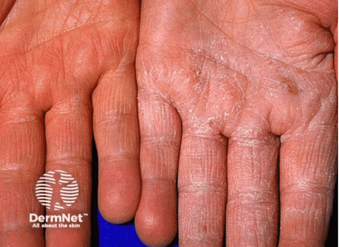 <em>źródło zdjęcia: </em><a style="text-decoration:none;" href="https://dermnetnz.org/imagedetail/19353-hand-dermatitis"><span style="font-size: 11pt; font-family: Arial, sans-serif; color: rgb(17, 85, 204); background-color: transparent; font-style: italic; font-variant: normal; text-decoration: underline; text-decoration-skip-ink: none; vertical-align: baseline; white-space: pre-wrap;"></span><em>https://dermnetnz.org/imagedetail/19353-hand-dermatitis</em></a><em></em>