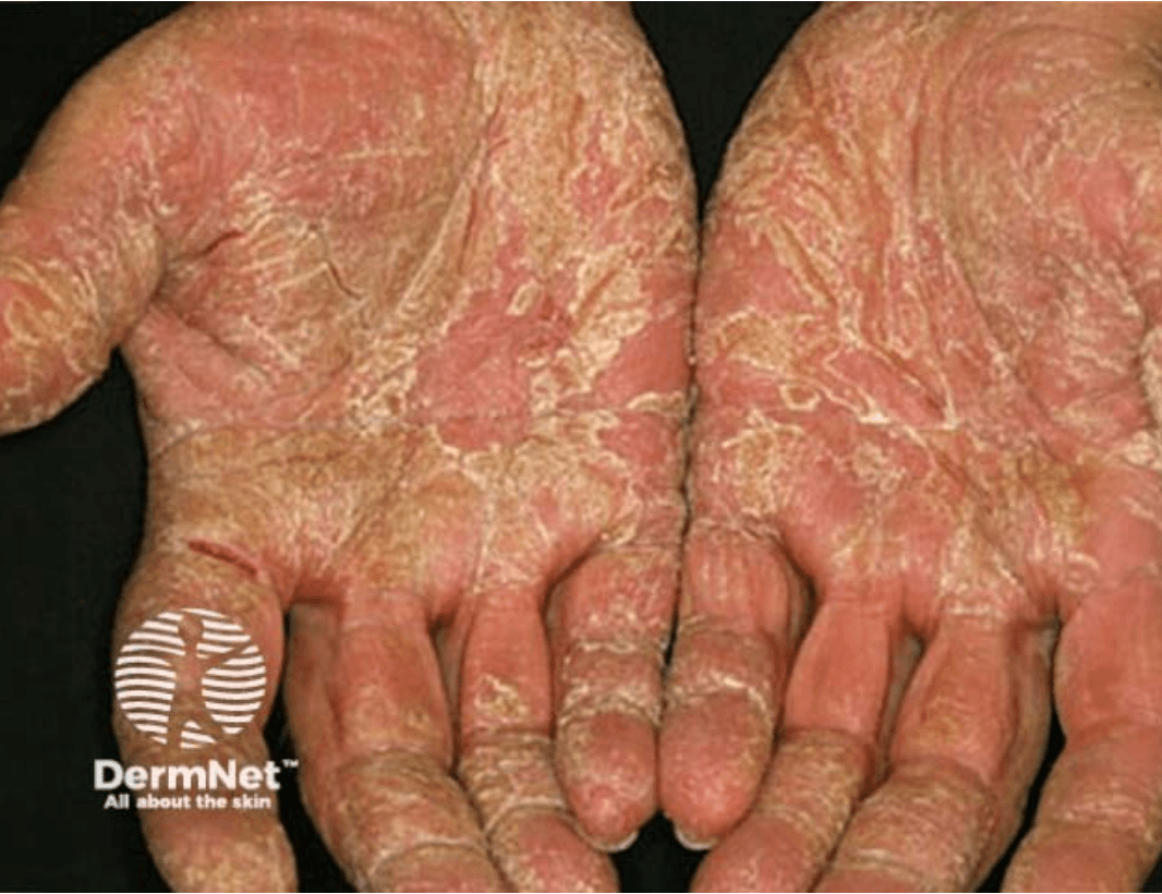 <em data-empty="false">źródło zdjęcia: </em><a style="text-decoration:none;" href="https://dermnetnz.org/imagedetail/19370-hand-dermatitis" data-empty="false"><span style="font-size: 11pt; font-family: Arial, sans-serif; color: rgb(17, 85, 204); background-color: transparent; font-style: italic; font-variant: normal; text-decoration: underline; text-decoration-skip-ink: none; vertical-align: baseline; white-space: pre-wrap;"></span><em>https://dermnetnz.org/imagedetail/19370-hand-dermatitis</em></a><em data-empty="true"></em><div data-empty="true"><br></div>