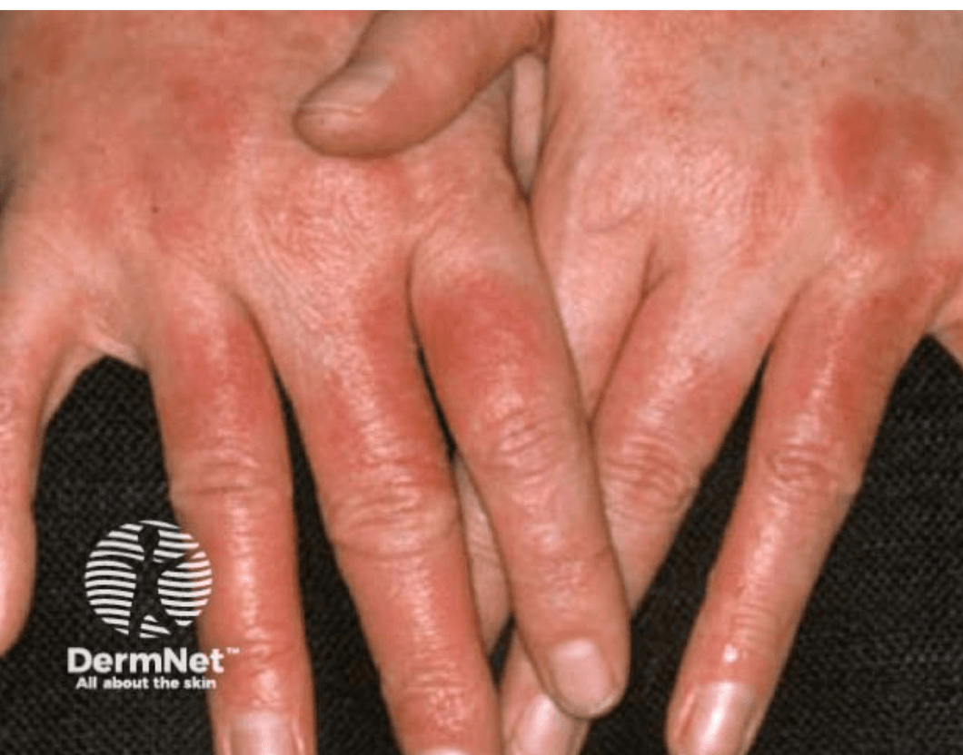 <em>źródło zdjęcia: </em><a style="text-decoration:none;" href="https://dermnetnz.org/imagedetail/19346-hand-dermatitis"><span style="font-size: 11pt; font-family: Arial, sans-serif; color: rgb(17, 85, 204); background-color: transparent; font-style: italic; font-variant: normal; text-decoration: underline; text-decoration-skip-ink: none; vertical-align: baseline; white-space: pre-wrap;"></span><em>https://dermnetnz.org/imagedetail/19346-hand-dermatitis</em></a><em></em>