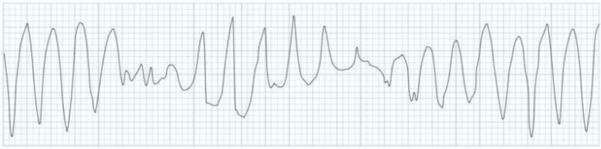 Torsades de pointes