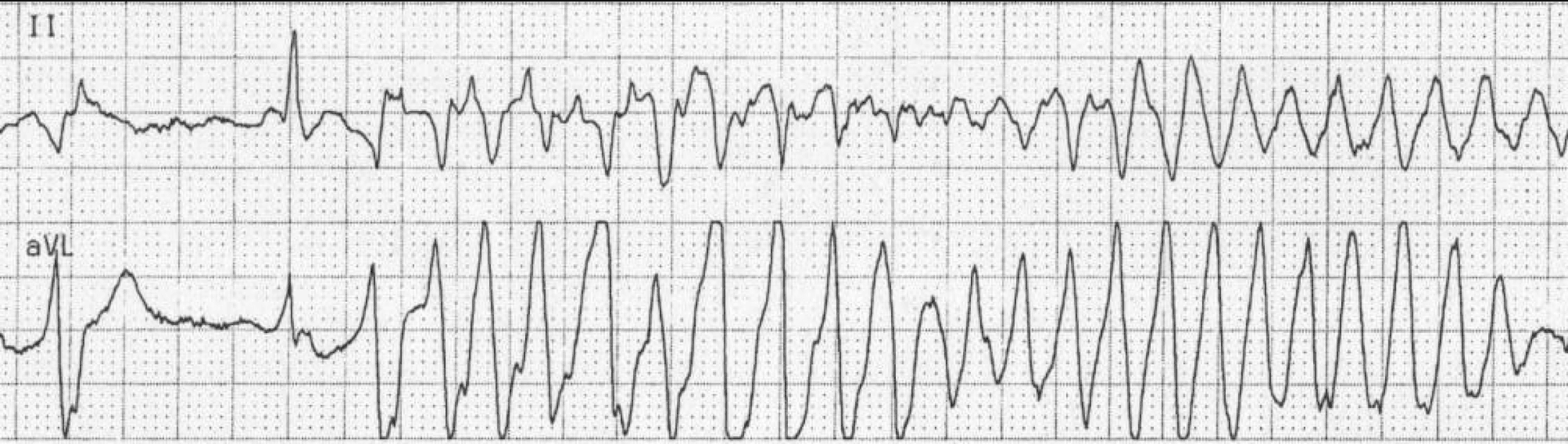 Torsades de pointes