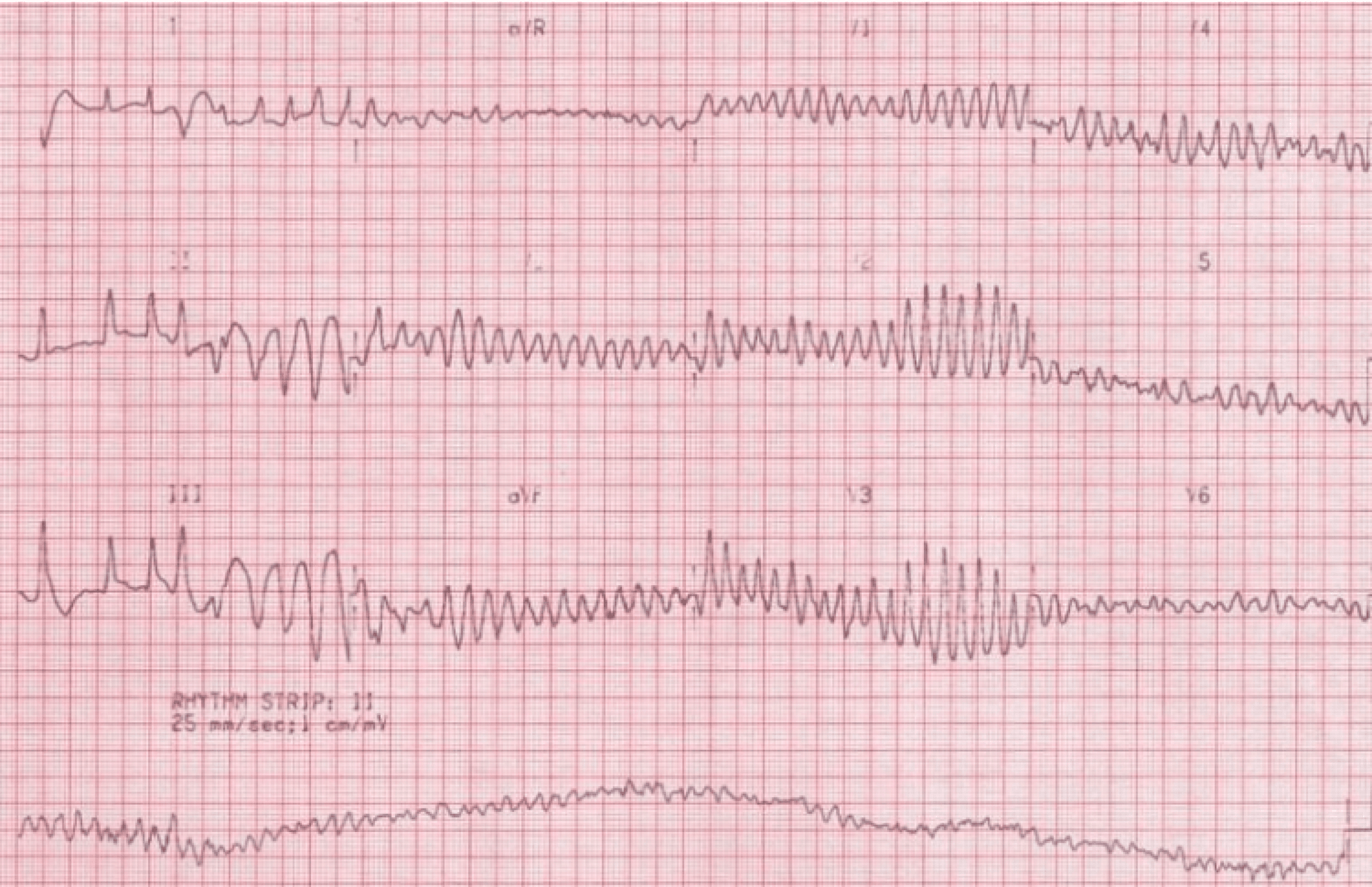 Torsades de pointes