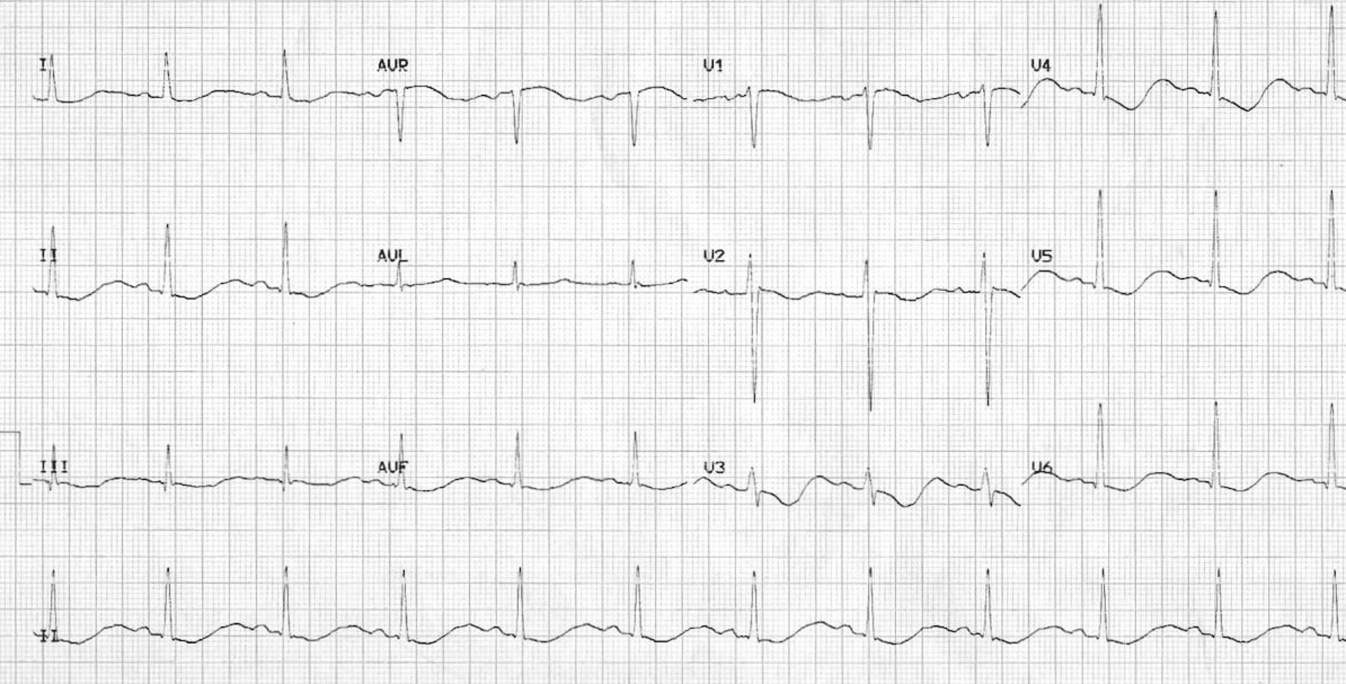 EKG pacjenta z hipokaliemią