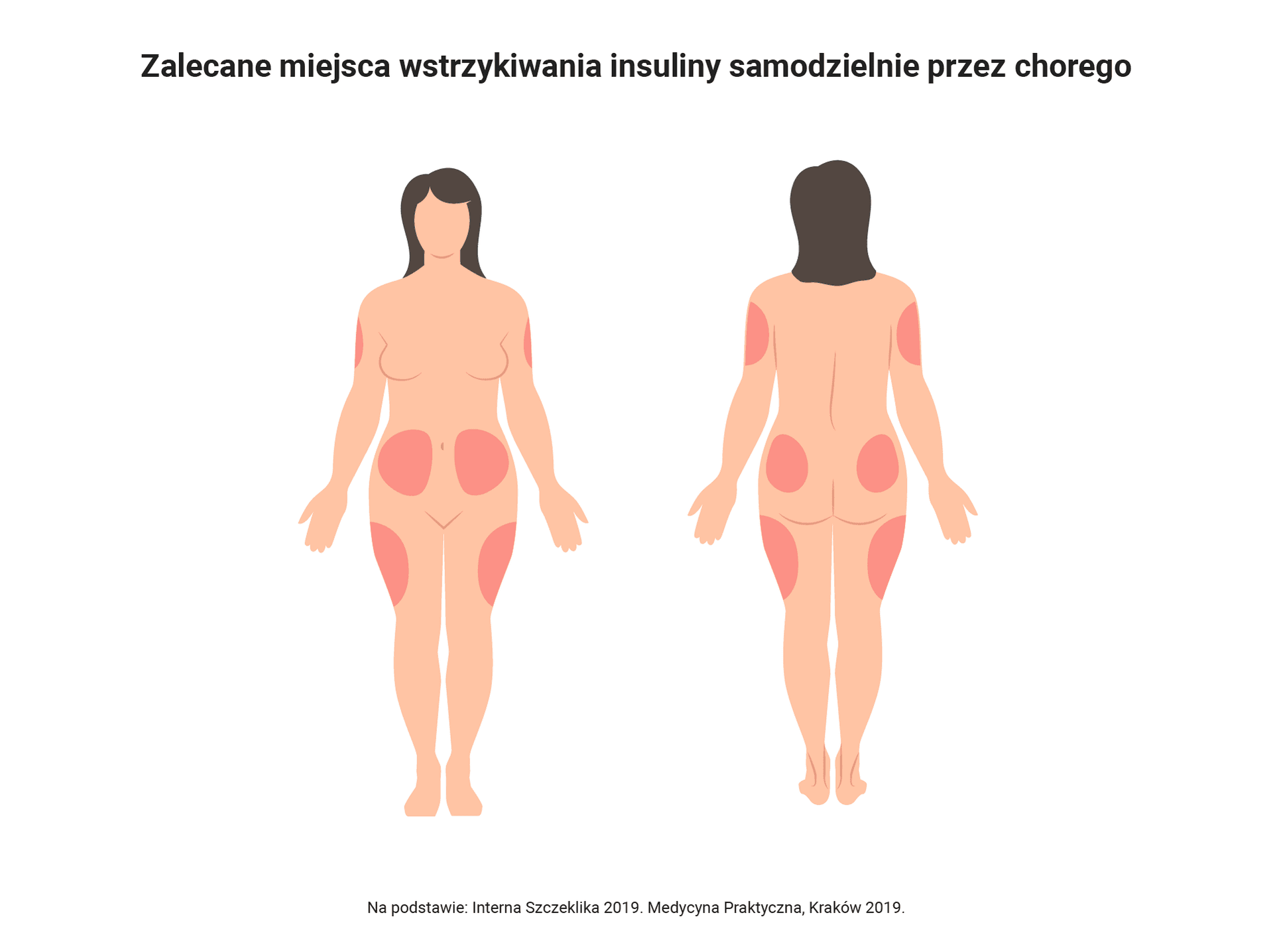 Zalecane miejsca wstrzykiwania insuliny samodzielnie przez chorego
