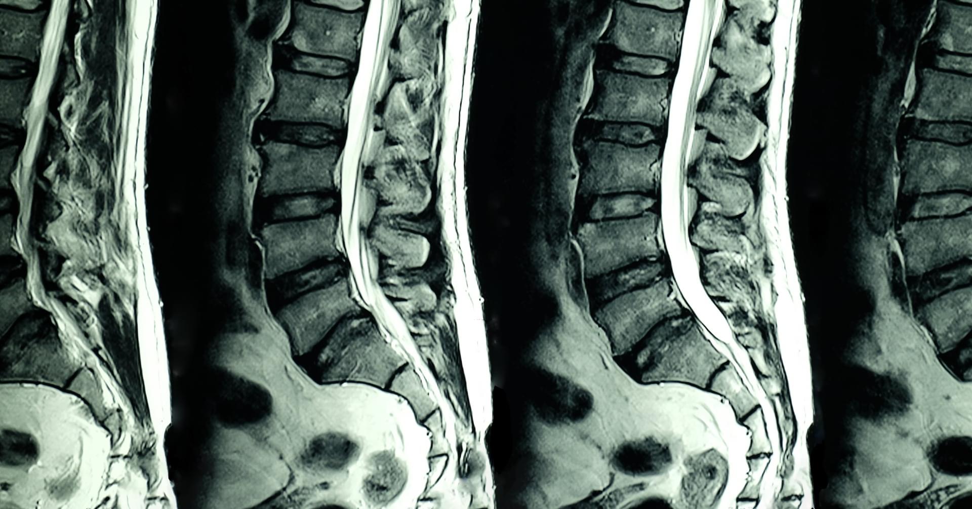 Neuroradiologia IV – rdzeń kręgowy i kanał kręgowy