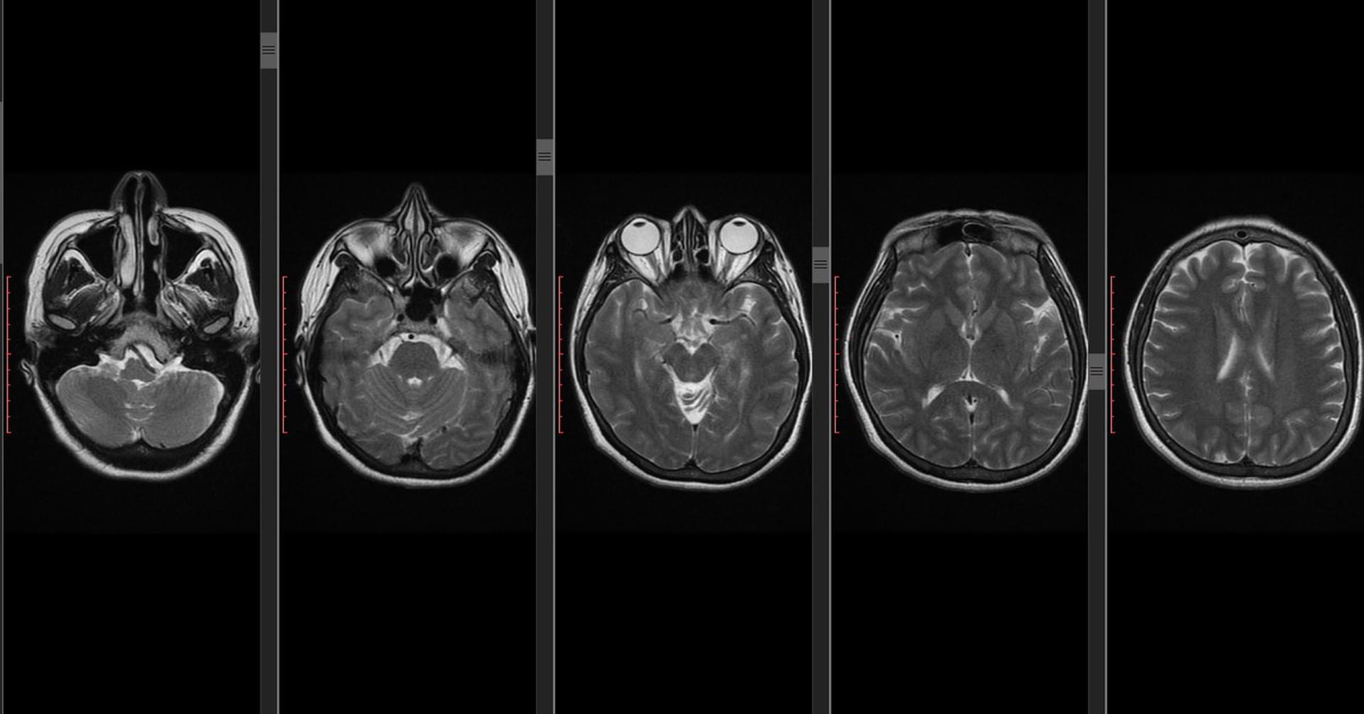 Neuroradiologia III – podstawa czaszki i nerwy czaszkowe