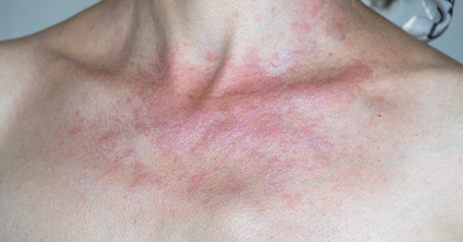 Fotowrażliwość, autoimmunologiczne nodoparanodopatie - algorytm diagnostyczny i terapeutyczny