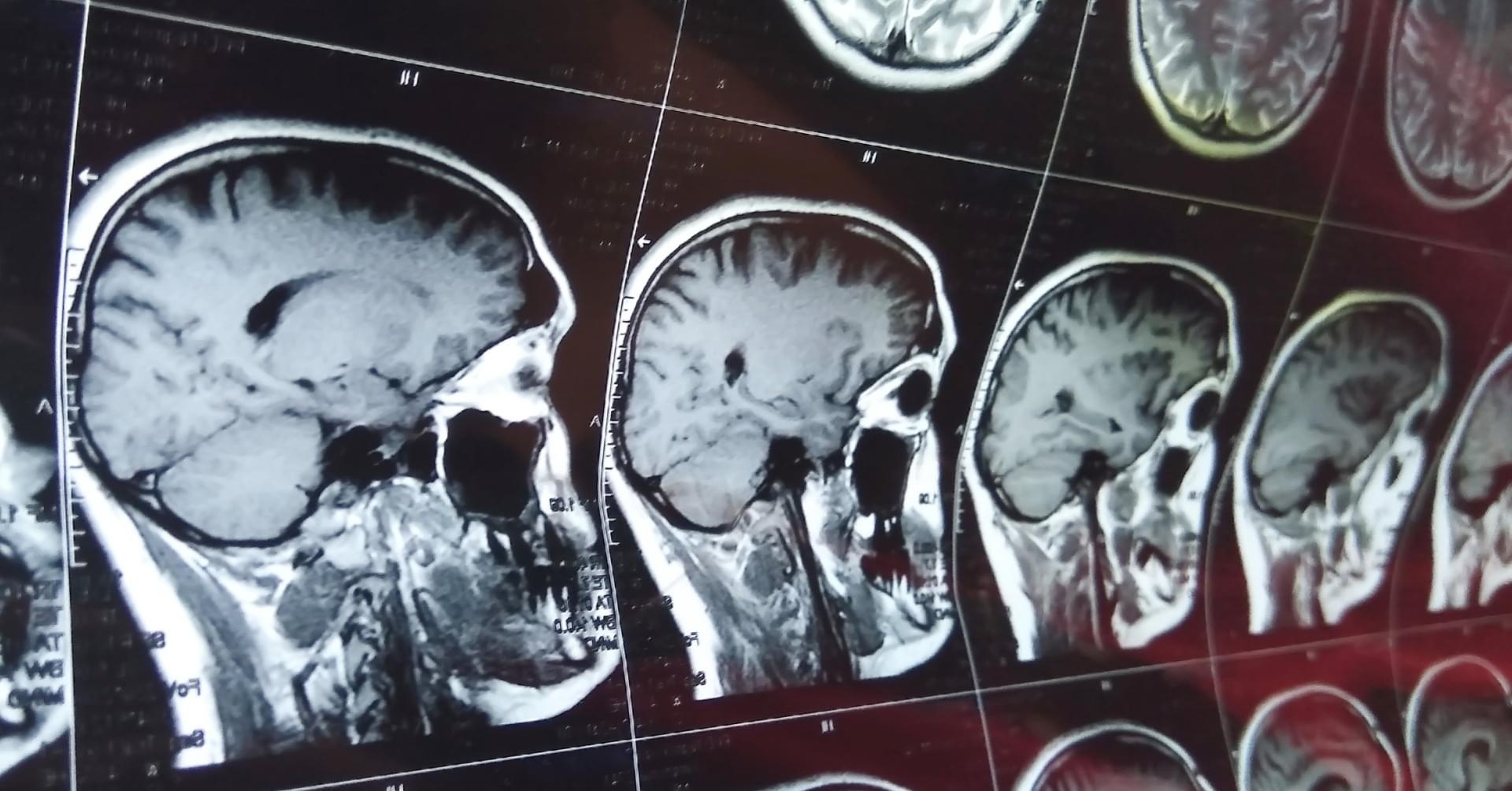 Neuroradiologia III