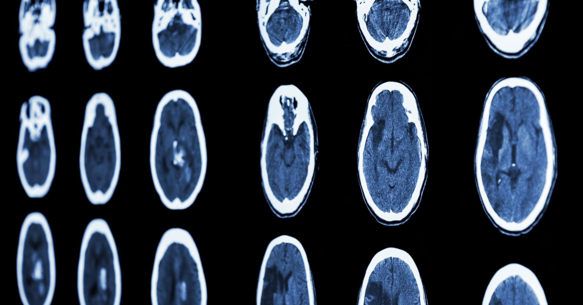 Neuroradiologia II